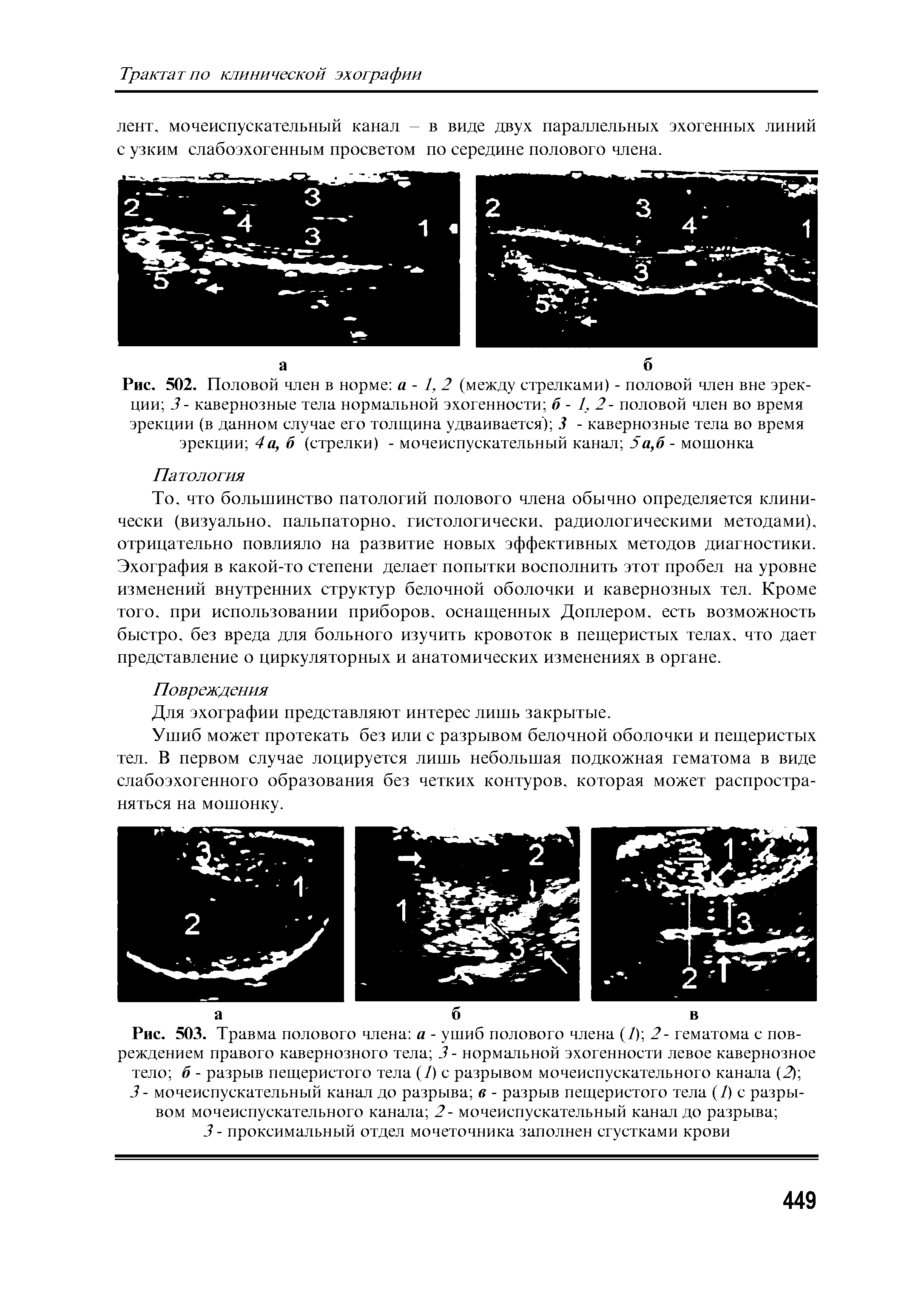 Рис. 503. Травма полового члена а - ушиб полового члена (/) 2- гематома с повреждением правого кавернозного тела 3 - нормальной эхогенности левое кавернозное тело б - разрыв пещеристого тела (/) с разрывом мочеиспускательного канала (2) ...