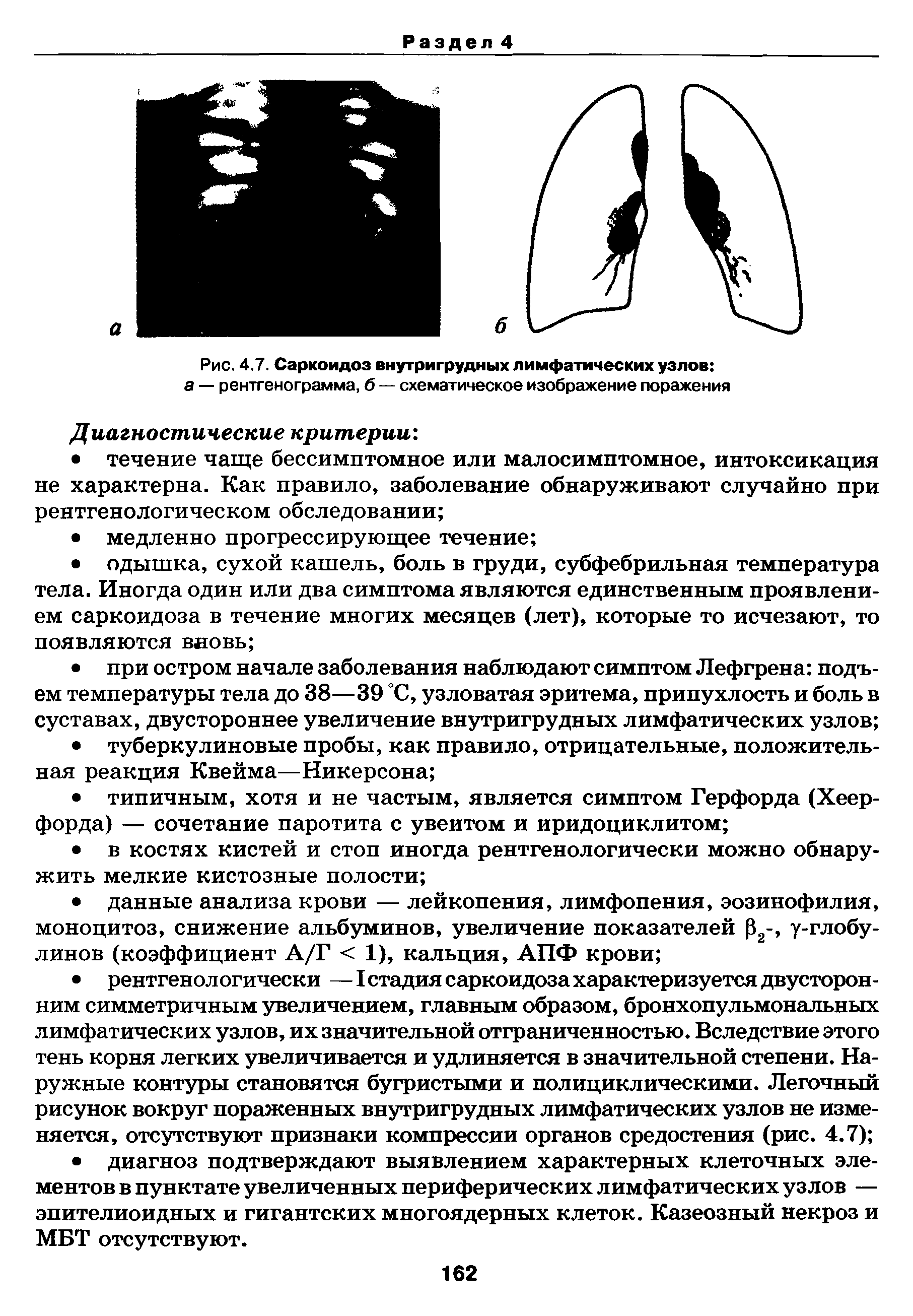 Рис. 4.7. Саркоидоз внутригрудных лимфатических узлов а — рентгенограмма, б — схематическое изображение поражения...