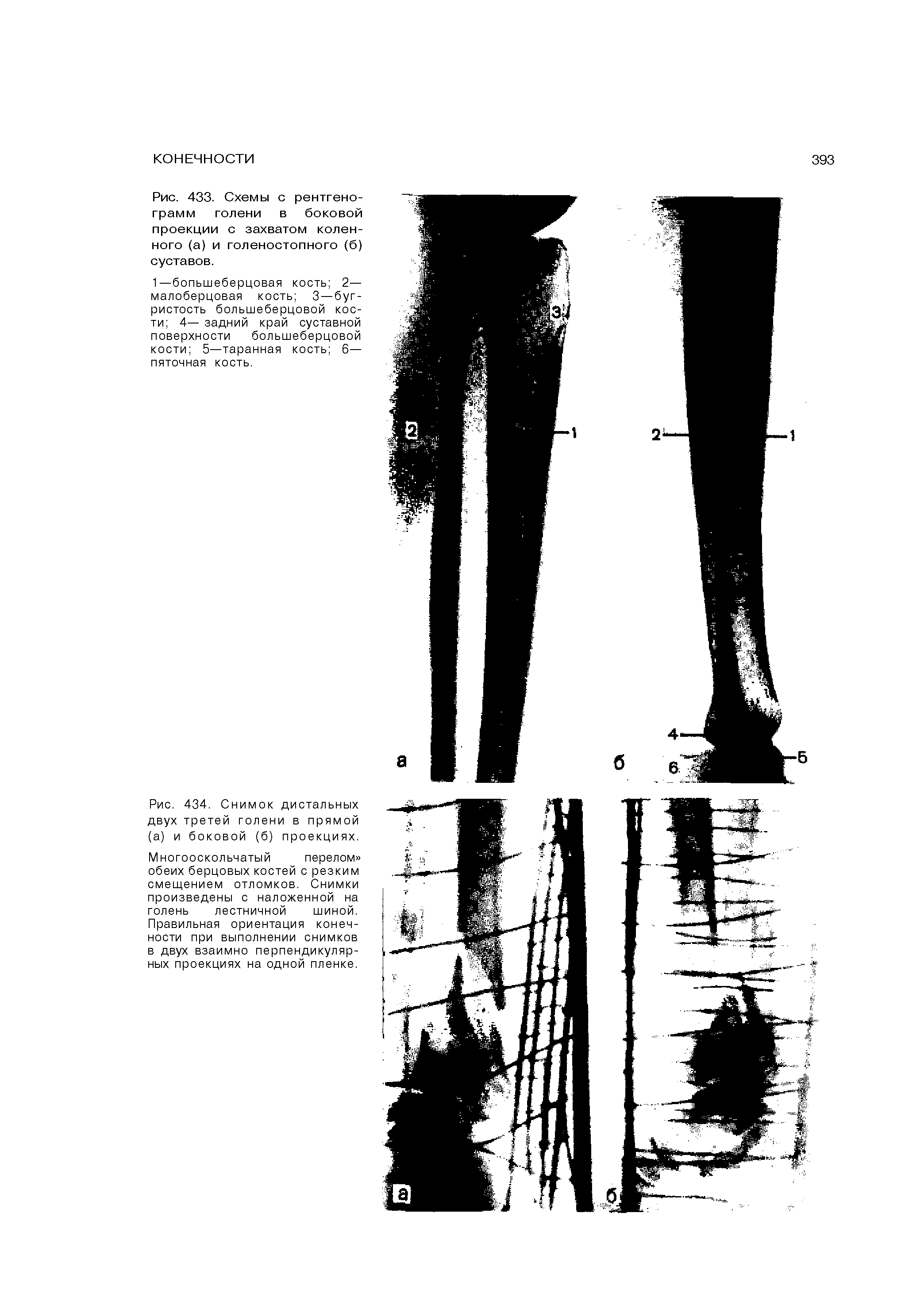 Рис. 433. Схемы с рентгенограмм голени в боковой проекции с захватом коленного (а) и голеностопного (б) суставов.
