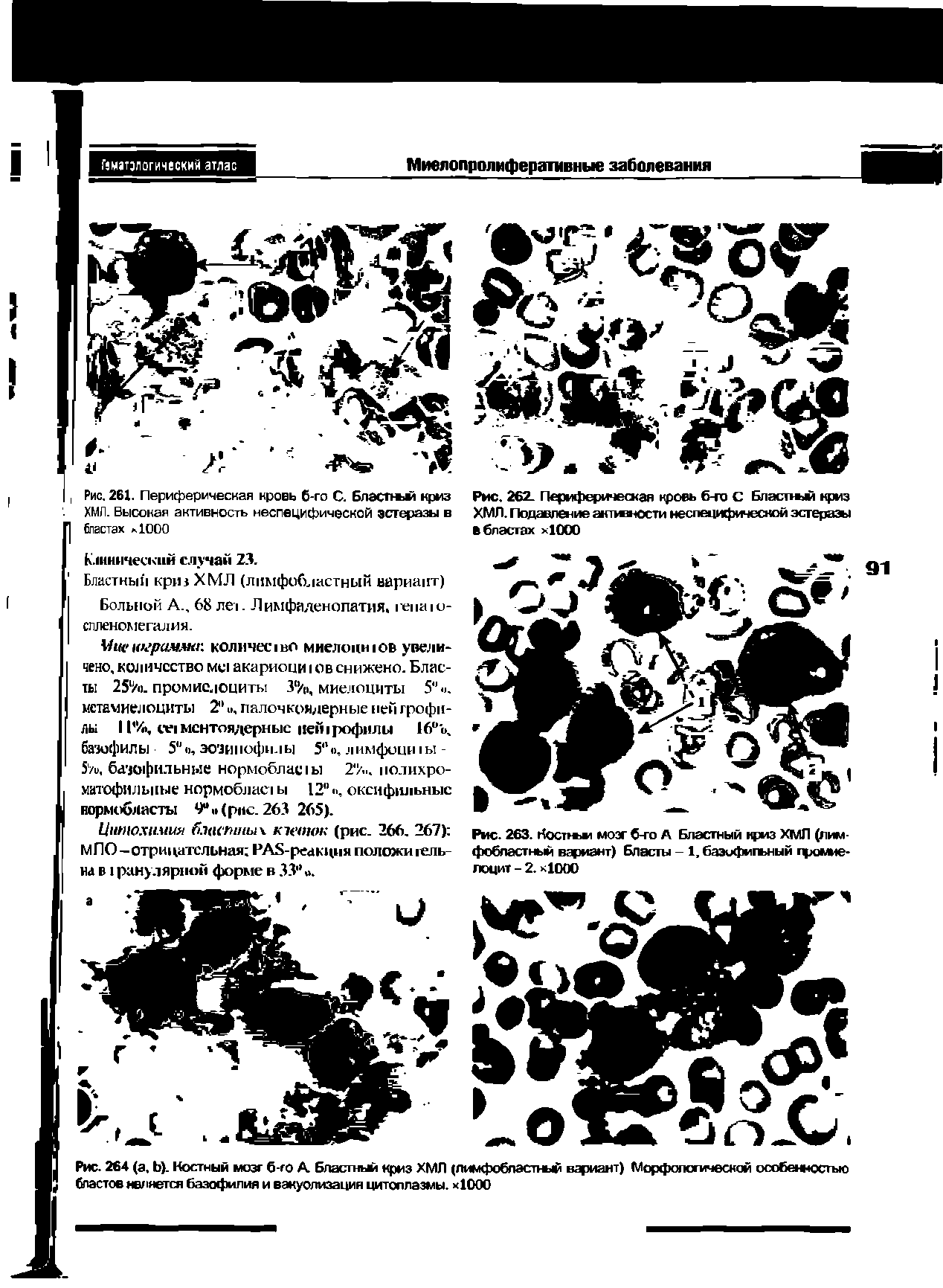 Рис. 261. Периферическая кровь б-го С. Бласпш криз ХМЛ. Высокая активность неспецифической эстеразы в бластах 1000...