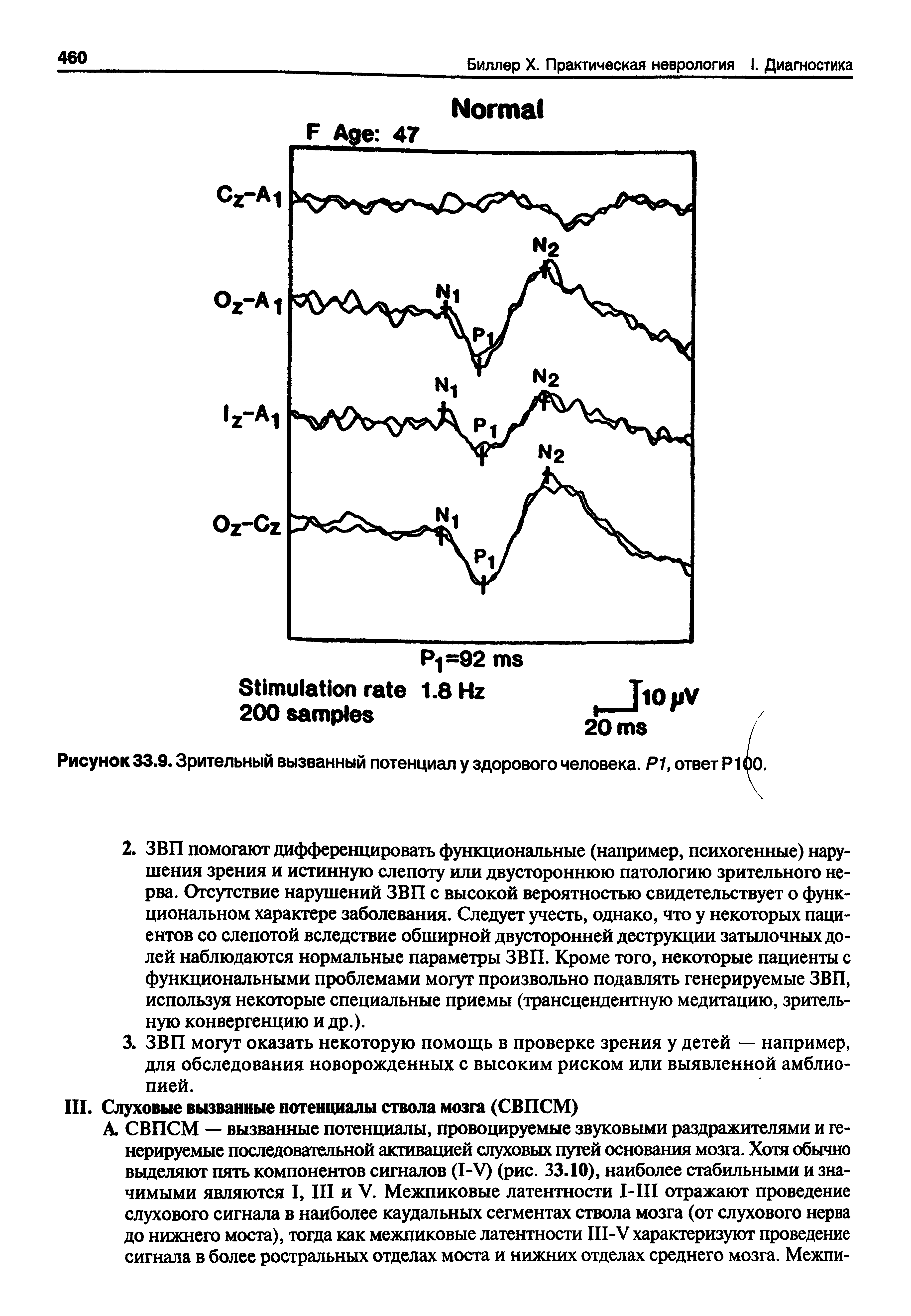 Рисунок 33.9. Зрительный вызванный потенциал у здорового человека. Р1, ответ Р1...