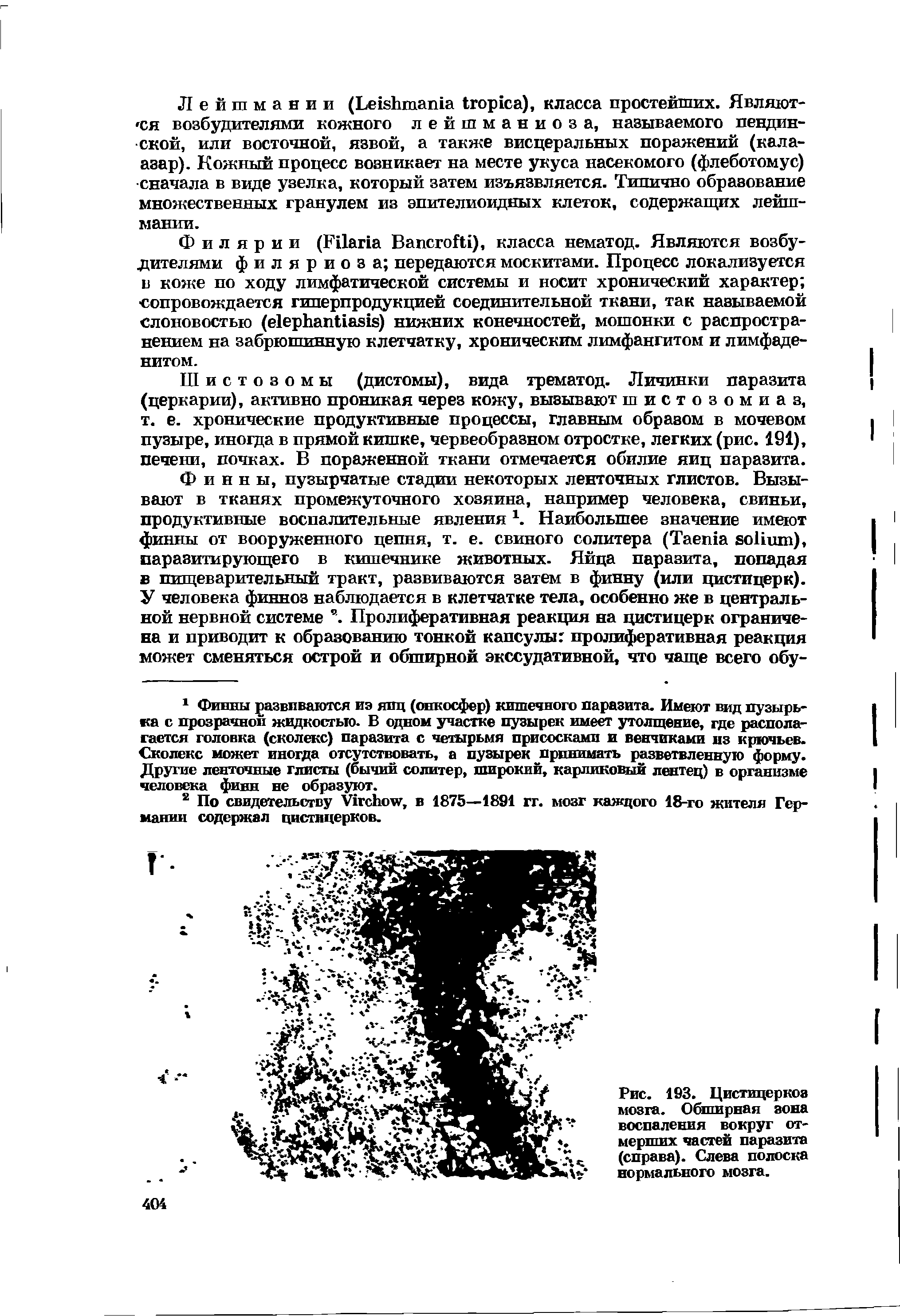 Рис. 193. Цистицеркоз мозга. Обширная зона воспаления вокруг отмерших частей паразита (справа). Слева полоска нормального мозга.