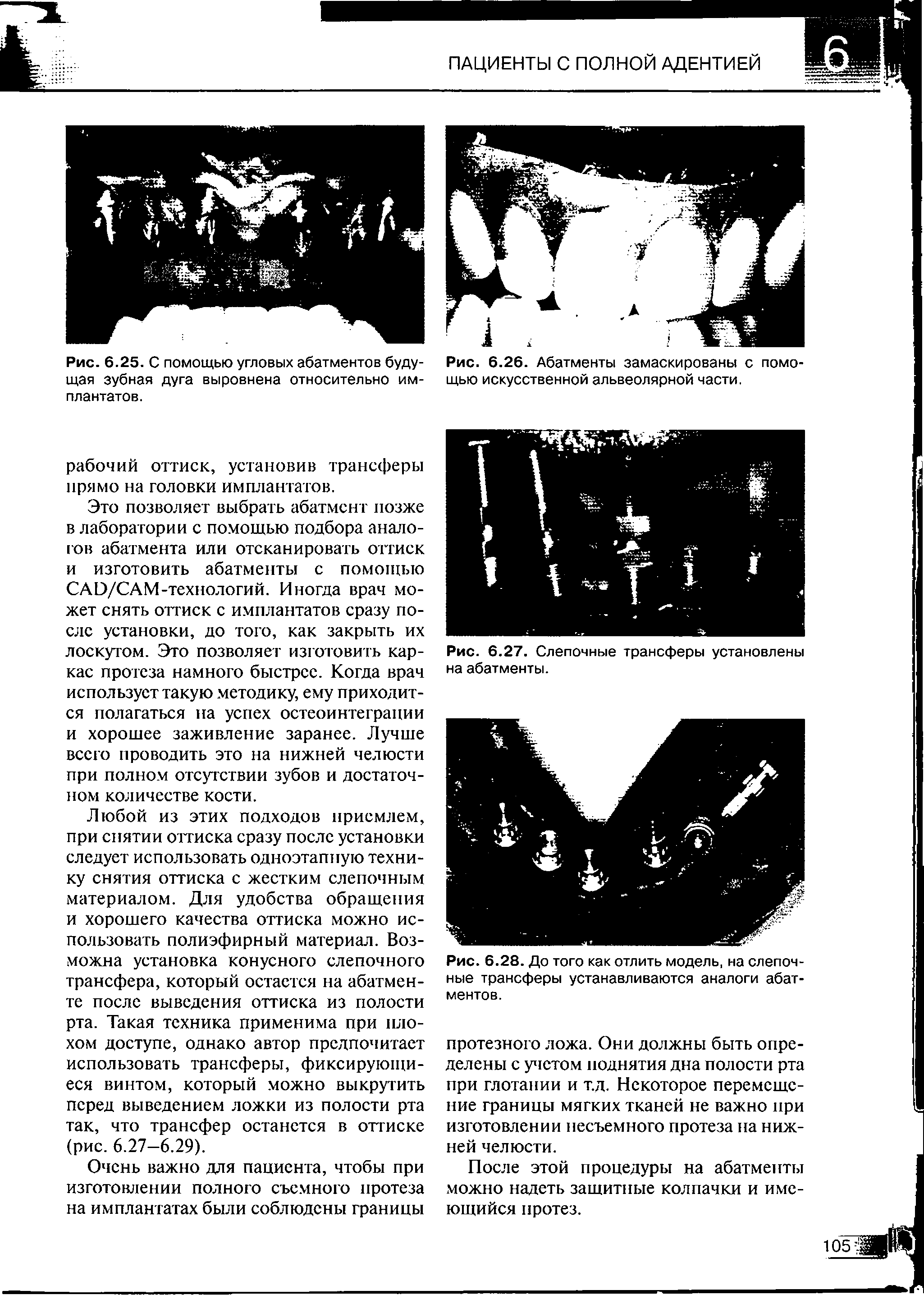 Рис. 6.28. До того как отлить модель, на слепочные трансферы устанавливаются аналоги абатментов.