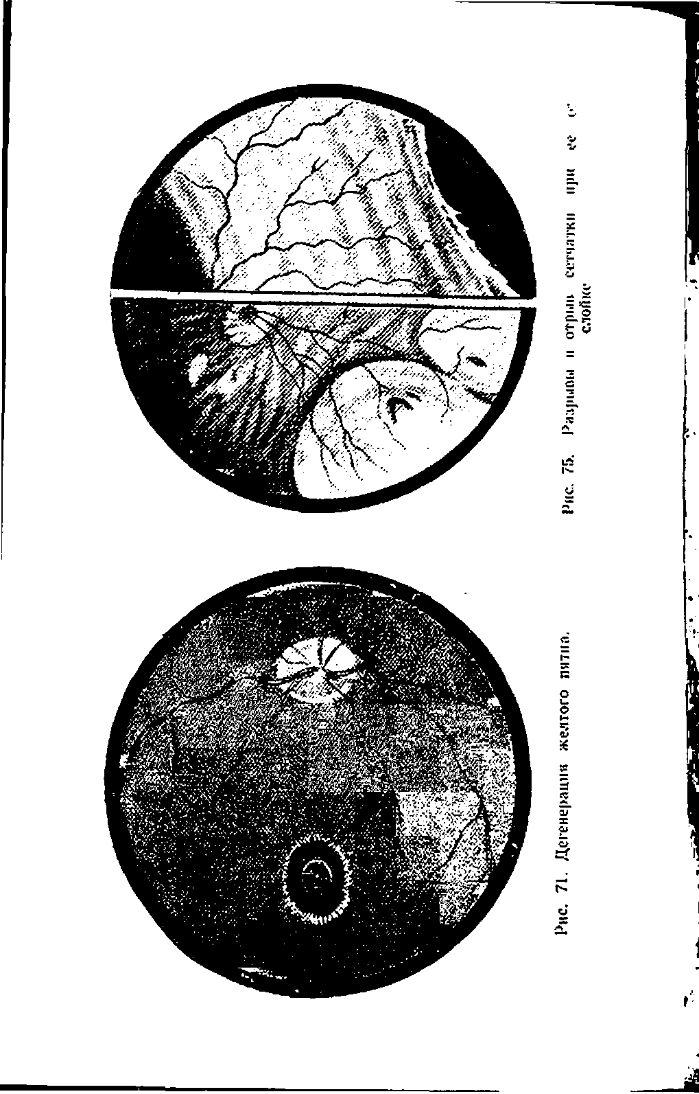 Рис. 71. Дегенерация желтого пятна. Рис 7Г>. раары(Ц отрыв сетчатки при...