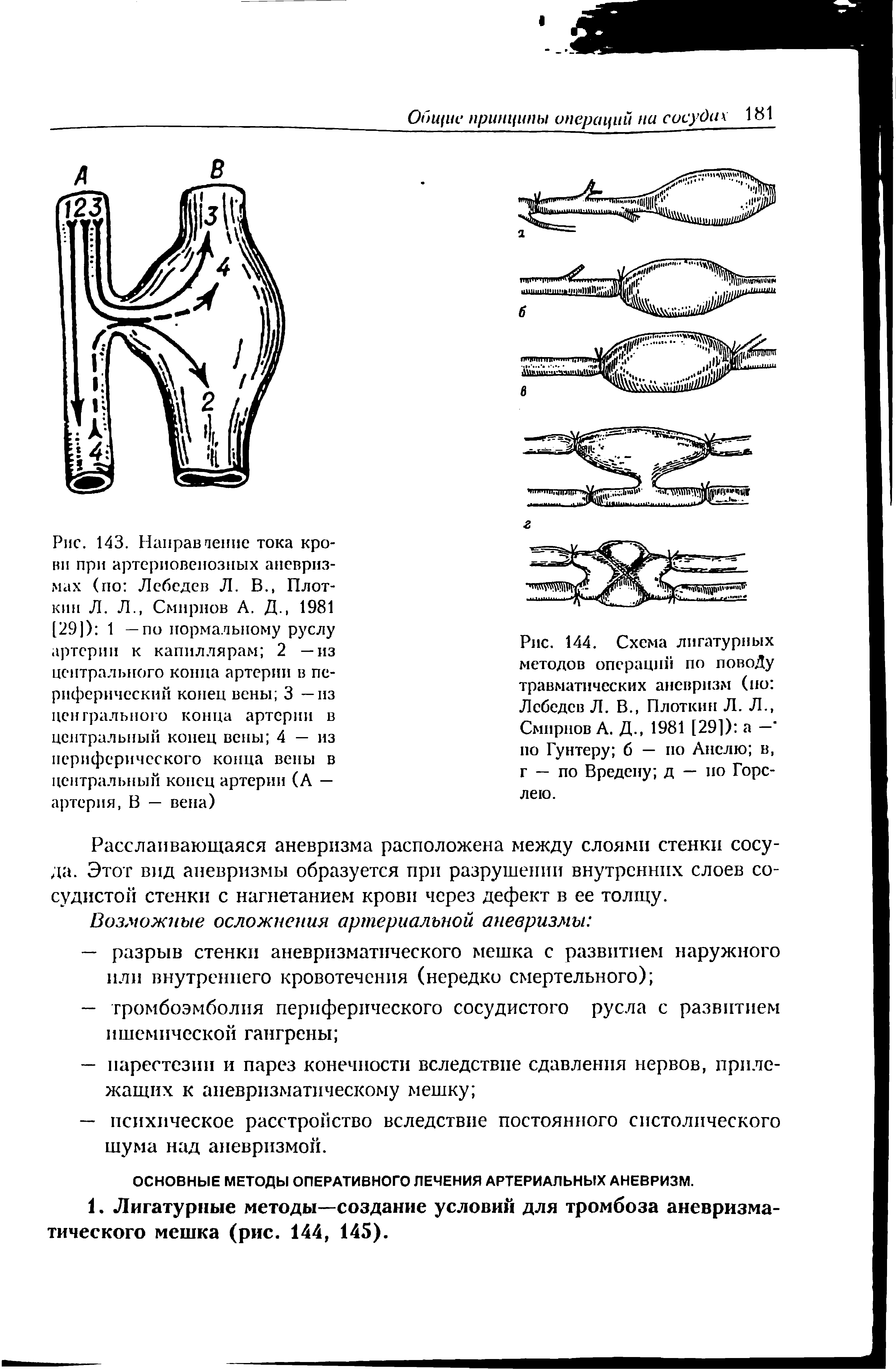 Рис. 144. Схема лигатурных методов операций по повоДу травматических аневризм (по Лебедев Л. В., Плоткин Л. Л., Смирнов А. Д., 1981 [291) а —" по Гунтеру б — по Анслю в, г — по Вредену д — по Горе-лею.