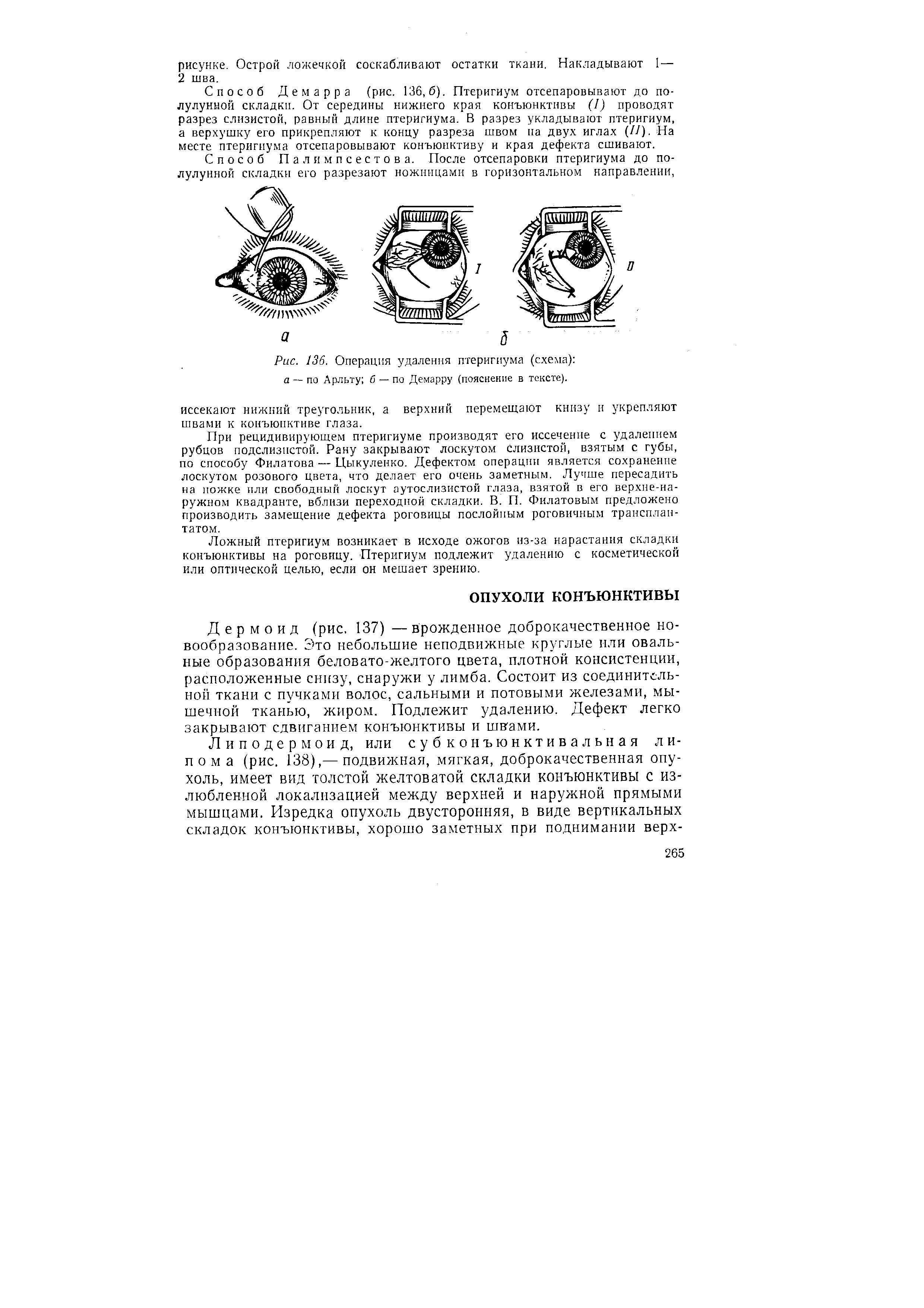 Рис. 136. Операция удаления птеригиума (схема) а — по Арльту б — по Демарру (пояснение в тексте).