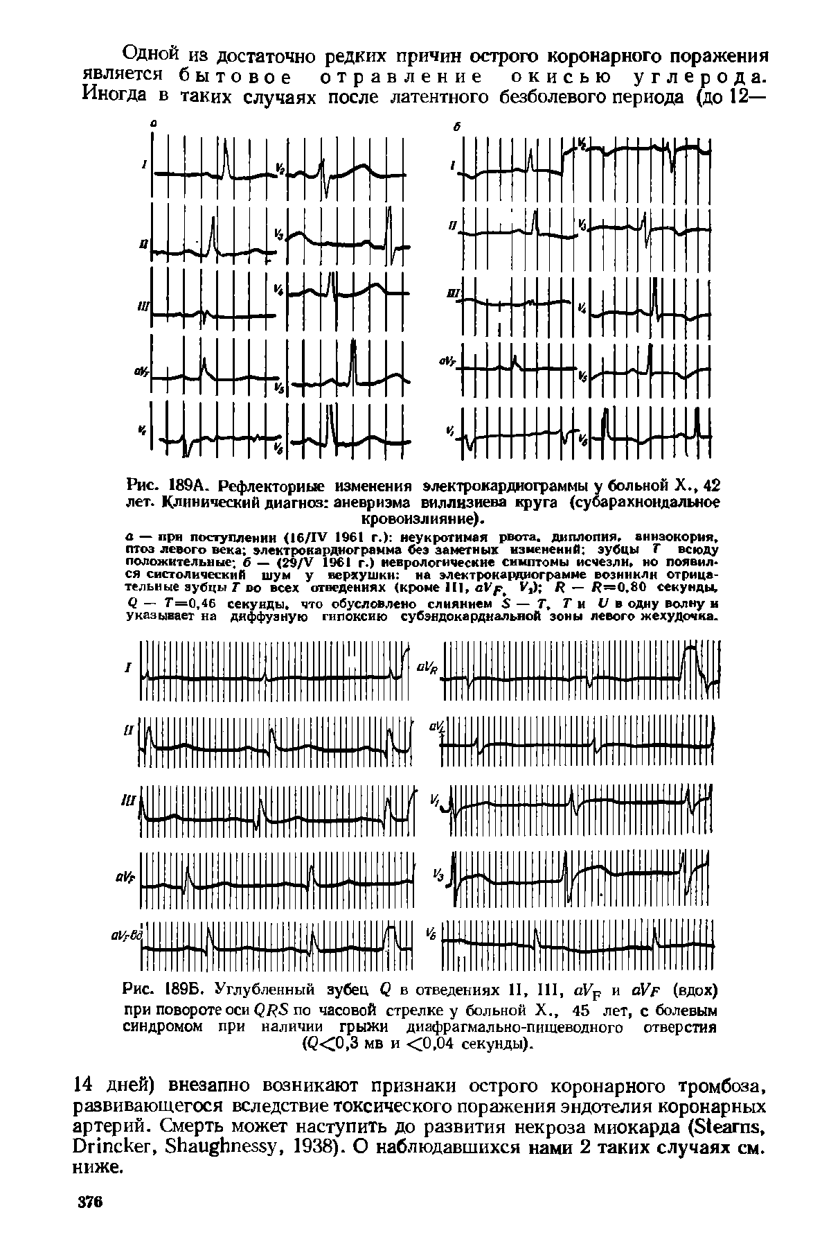 Рис. 189Б. Углубленный зубец Q в отведениях II, III, VF и аУр (вдох) при повороте оси QRS по часовой стрелке у больной X., 45 лет, с болевым синдромом при наличии грыжи диафрагмально-пищеводного отверстия (Q<0,3 мв и <0,04 секунды).