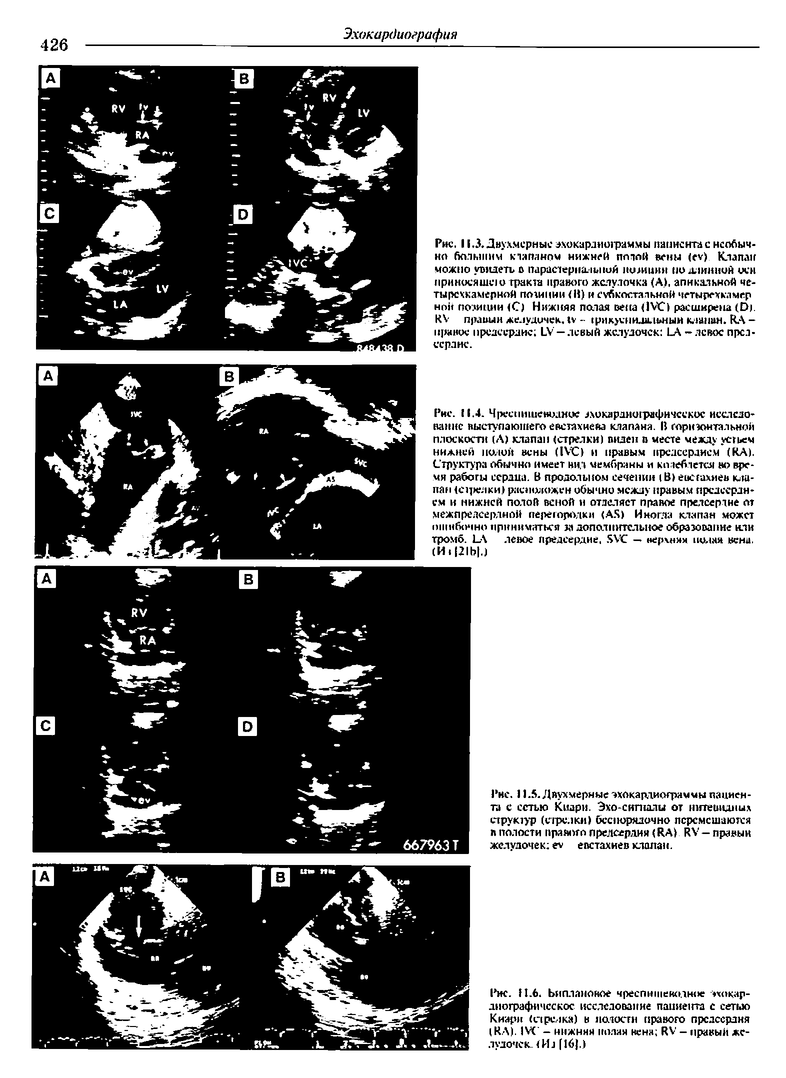 Рис. 11.5. Двухмерные эхокардиограммы пациента с сетью Киари. Эхо-сигналы от нитевидных структур (сгрслки) беспорядочно перемешаются лполости правого предсердия (ЯА) КУ —правый желудочек е евстахиев клапан.