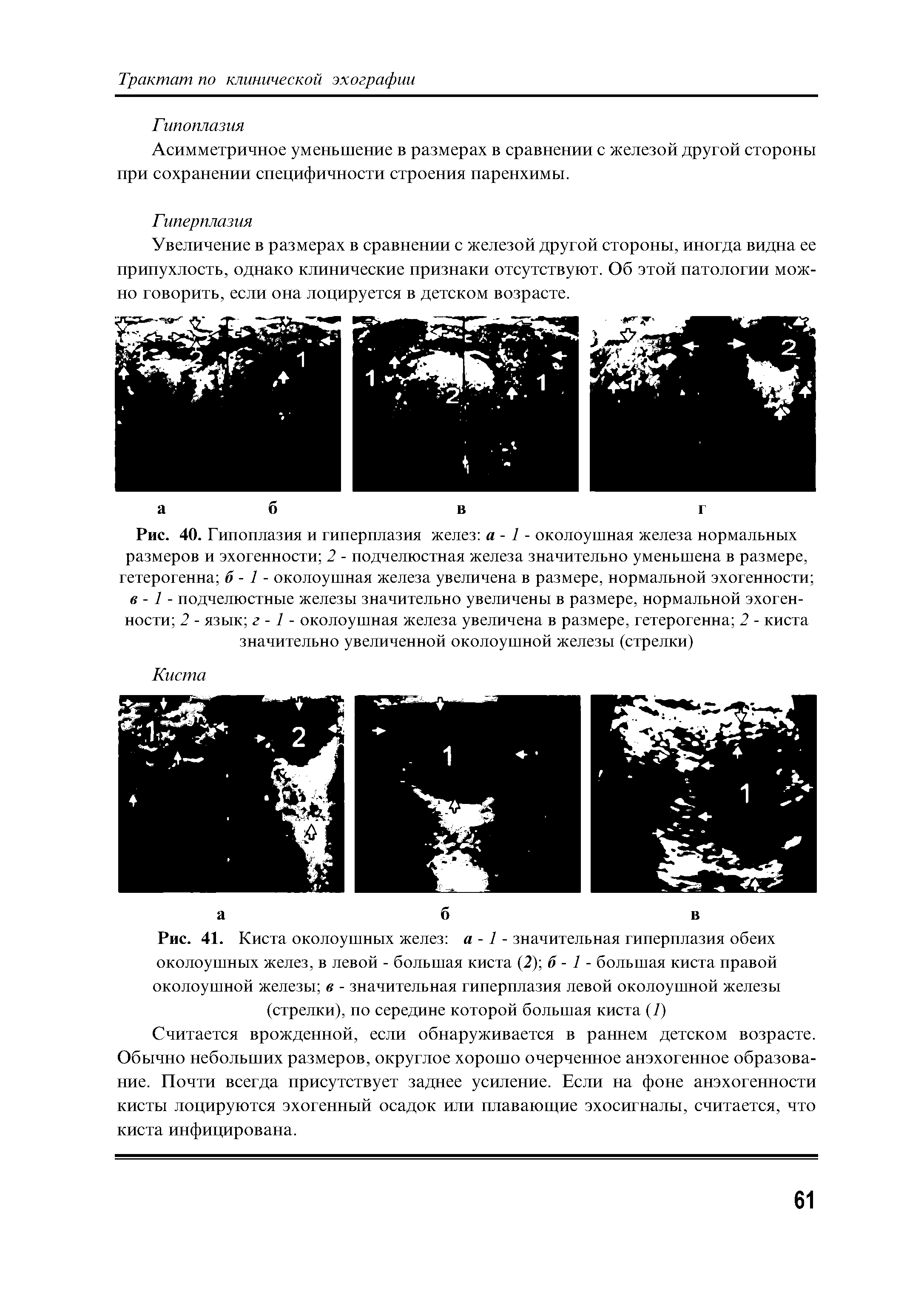 Рис. 41. Киста околоушных желез а -1 - значительная гиперплазия обеих околоушных желез, в левой - большая киста (2) б - 1 - большая киста правой околоушной железы в - значительная гиперплазия левой околоушной железы (стрелки), по середине которой большая киста (7)...