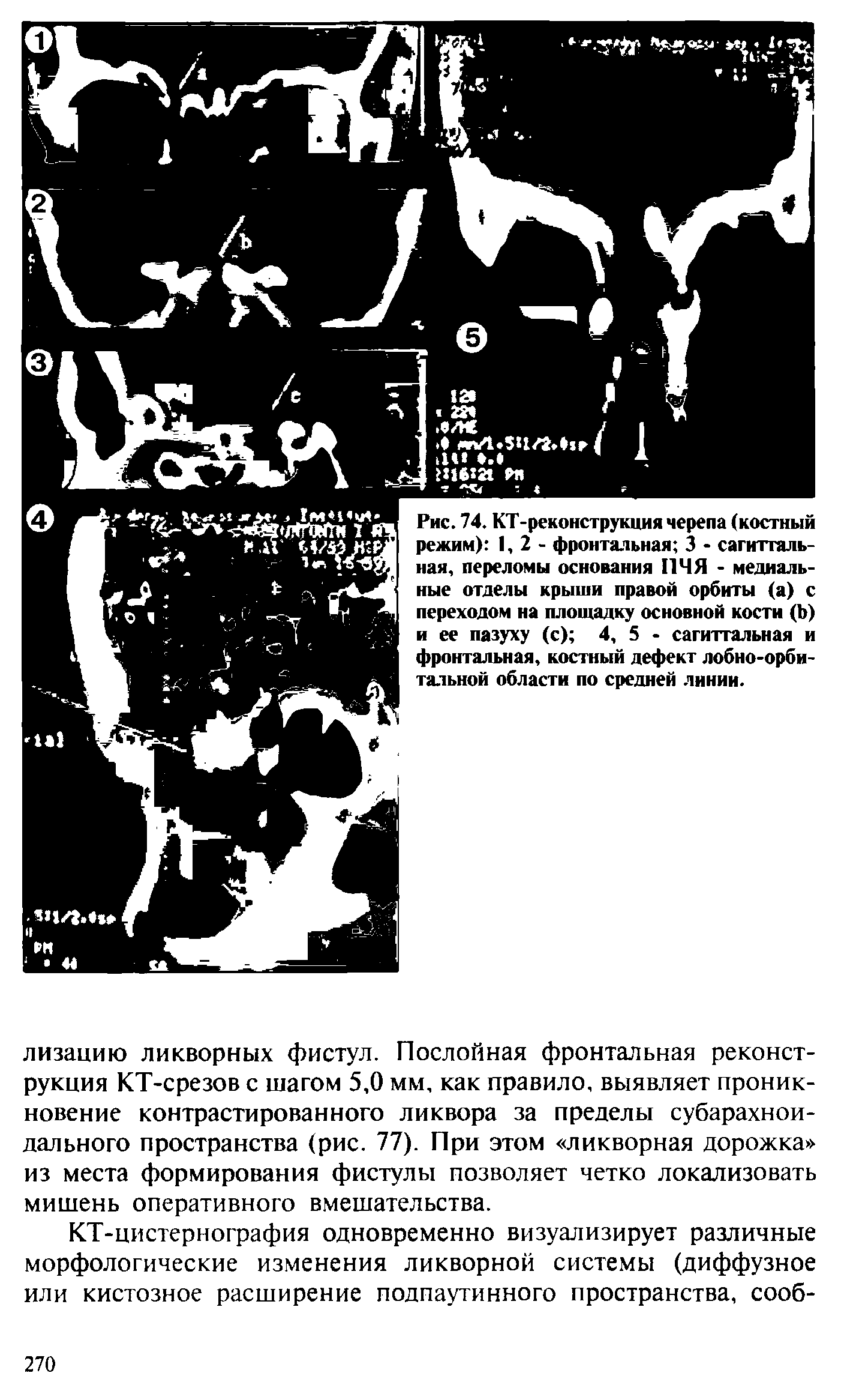 Рис. 74. КТ-реконструкция черепа (костный режим) 1,2- фронтальная 3 - сагиттальная, переломы основания ПЧЯ - медиальные отделы крыши правой орбиты (а) с переходом на площадку основной кости (Ъ) и ее пазуху (с) 4, 5 - сагиттальная и...