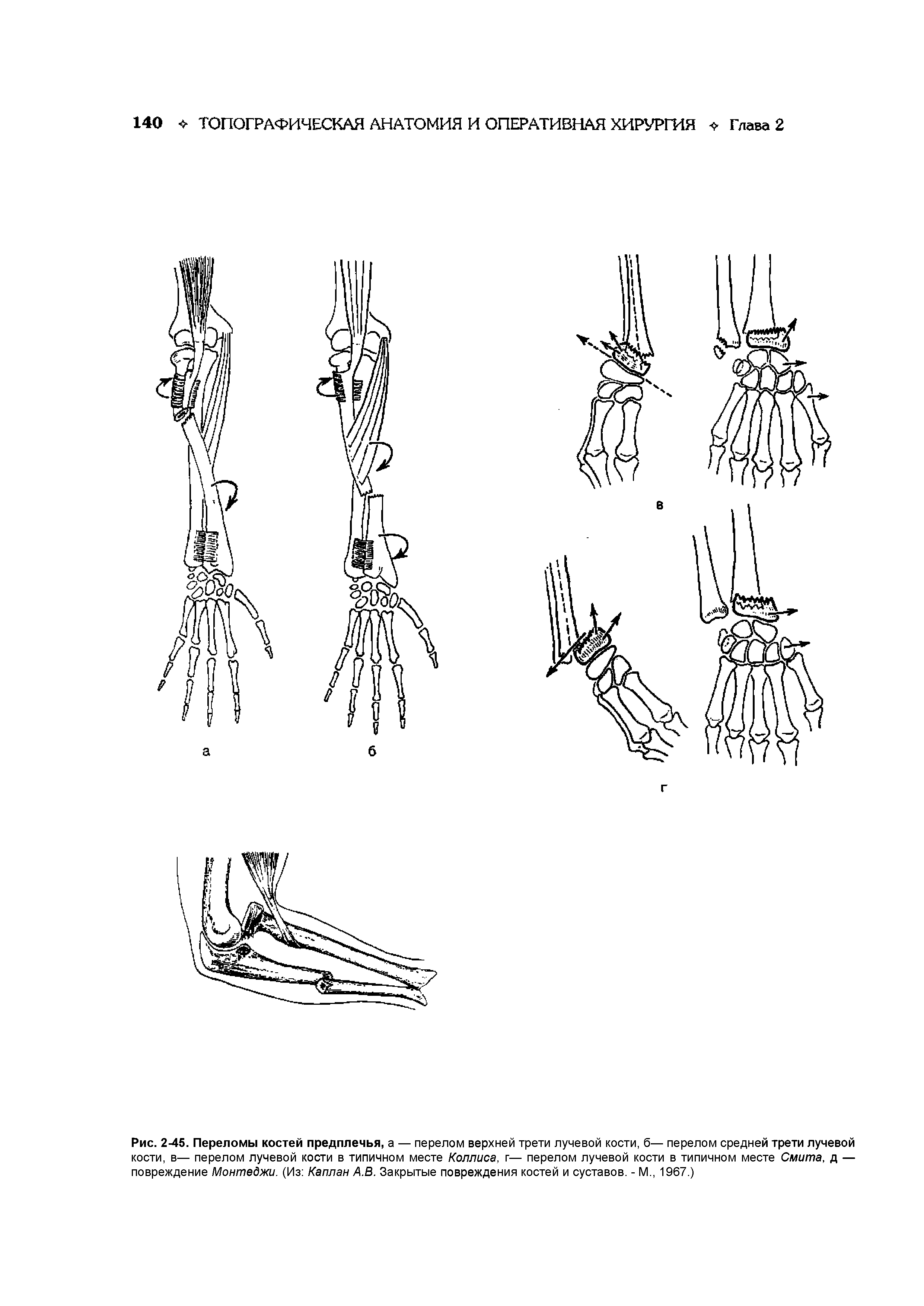 Рис. 2-45. Переломы костей предплечья, а — перелом верхней трети лучевой кости, б— перелом средней трети лучевой кости, в— перелом лучевой кости в типичном месте Коллиса, г— перелом лучевой кости в типичном месте Смита, д — повреждение Монтеджи. (Из Каплан А.В. Закрытые повреждения костей и суставов. - М., 1967.)...