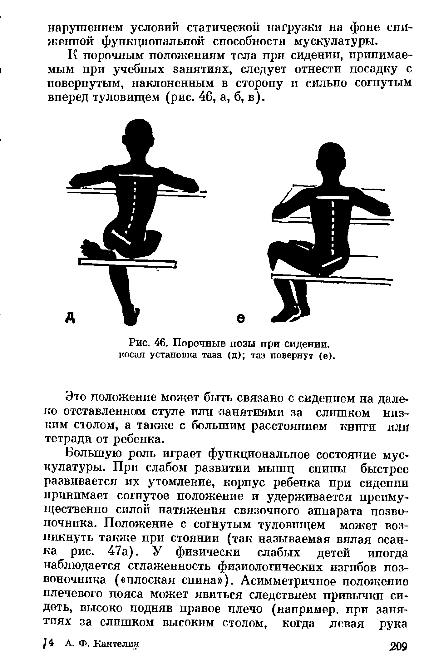 Рис. 46. Порочные позы при сидении, косая установка таза (д) таз повернут (е).