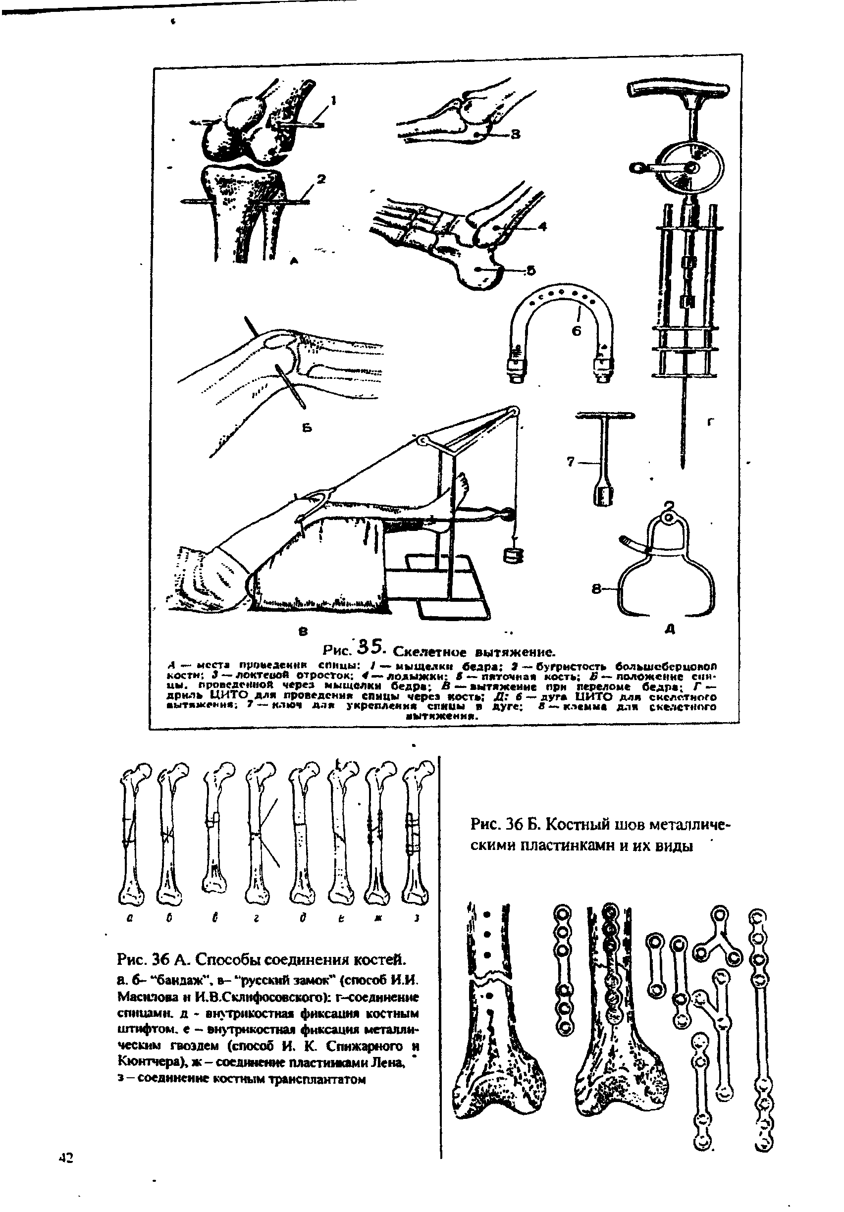 Рис. 36 А. Способы соединения костей, а. 6- бандаж, в- русский замок" (способ И.И. Маснлова и И.В.Склнфосовского) г-соедннснме спицами. д - внутрикостная фиксация костным штифтом, е - внутрикостная фиксация металлическим гвоздем (способ И. К. Спнжармого и КюнтчераХ ж-соединение пластинками Лена з - соединение костным трансплантатом...