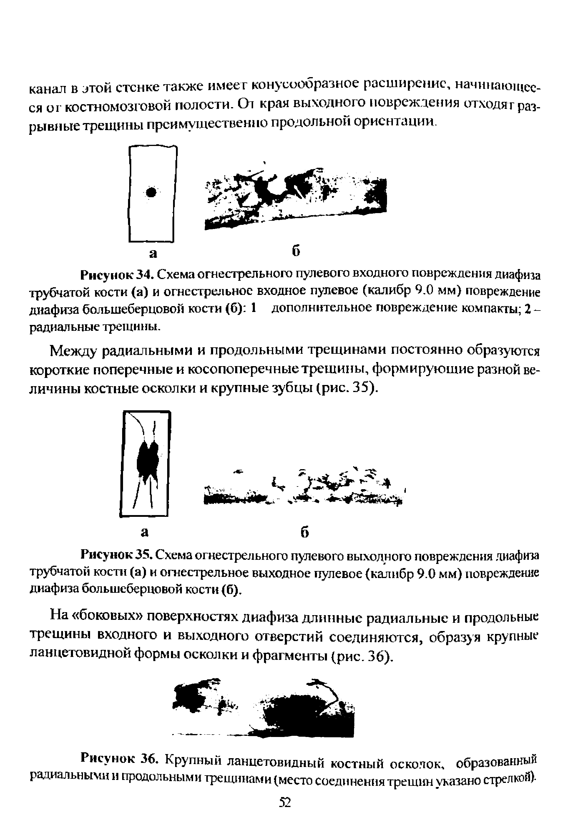 Рисунок 34. Схема огнестрельного пулевого входного повреждения диафиза трубчатой кости (а) и огнестрельное входное пулевое (калибр 9.0 мм) повреждение диафиза большеберцовой кости (б) 1 дополнительное повреждение компакты 2 -радиальные трещины.