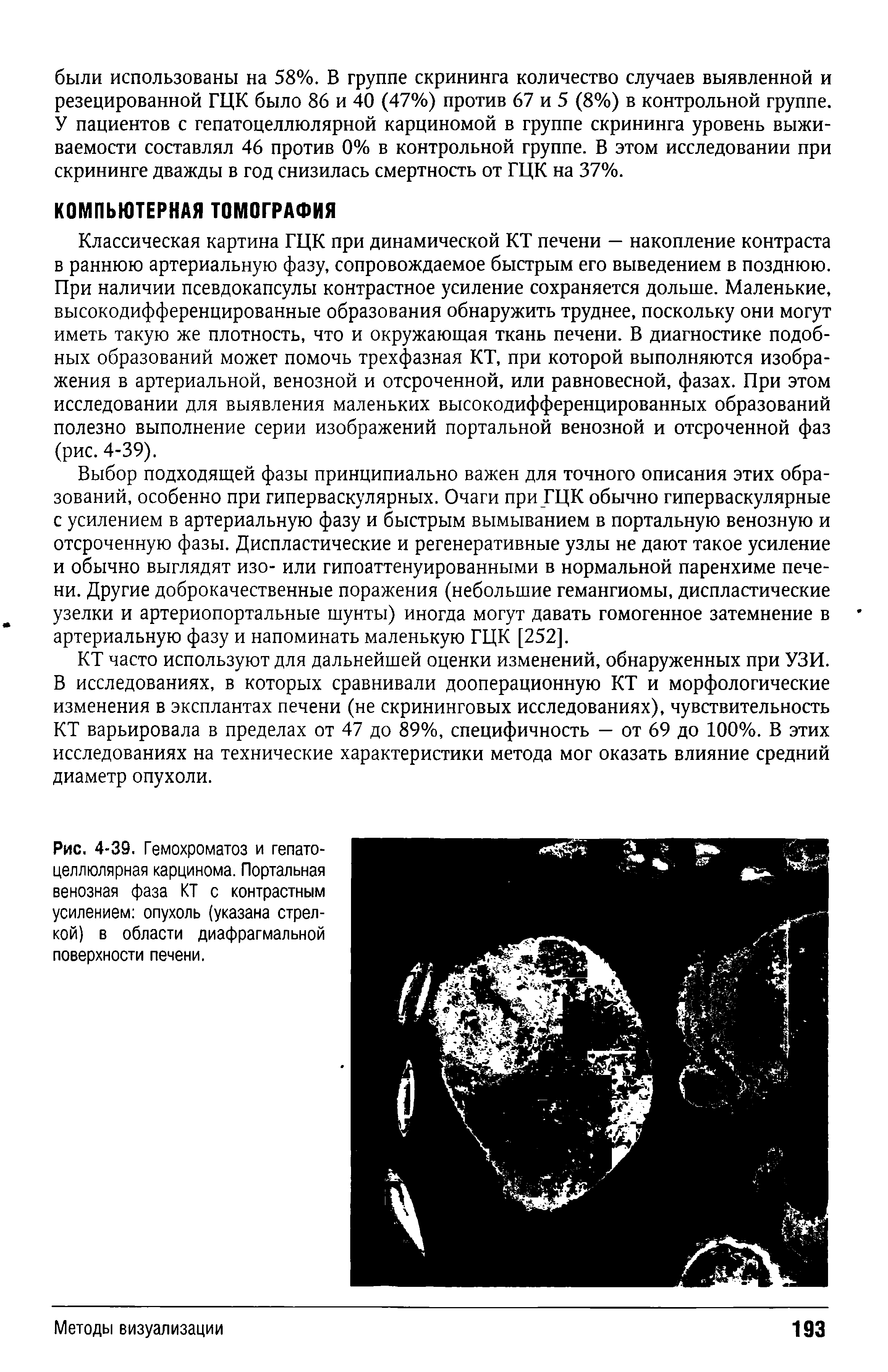 Рис. 4-39. Гемохроматоз и гепатоцеллюлярная карцинома. Портальная венозная фаза КТ с контрастным усилением опухоль (указана стрелкой) в области диафрагмальной поверхности печени.