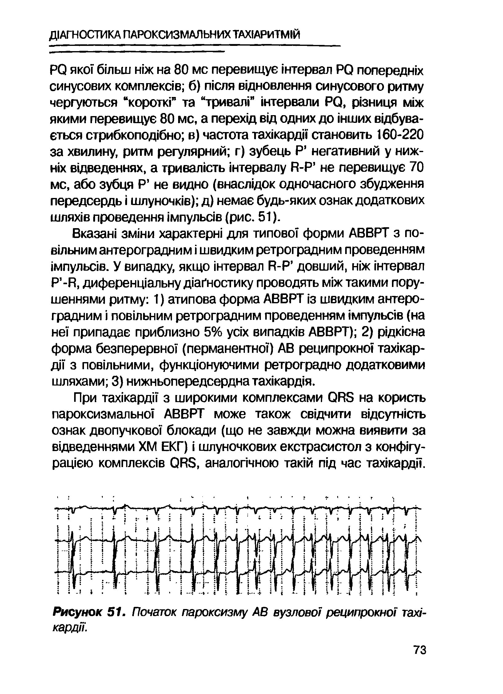 Рисунок 51. Початок пароксизму АВ вузлово/ реципрокно/ тахн кардп.