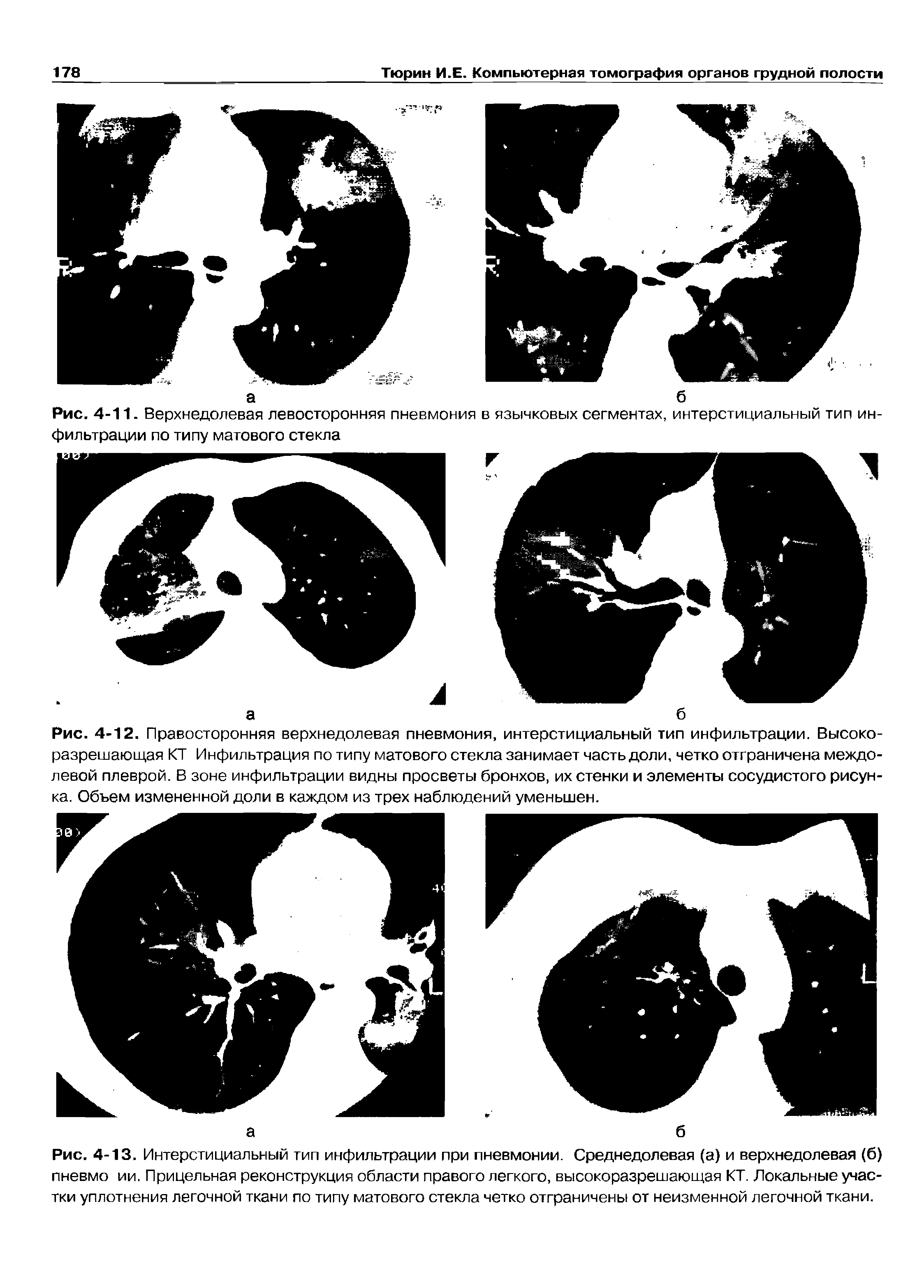 Рис. 4-11. Верхнедолевая левосторонняя пневмония в язычковых сегментах, интерстициальный тип фильтрации по типу матового стекла...