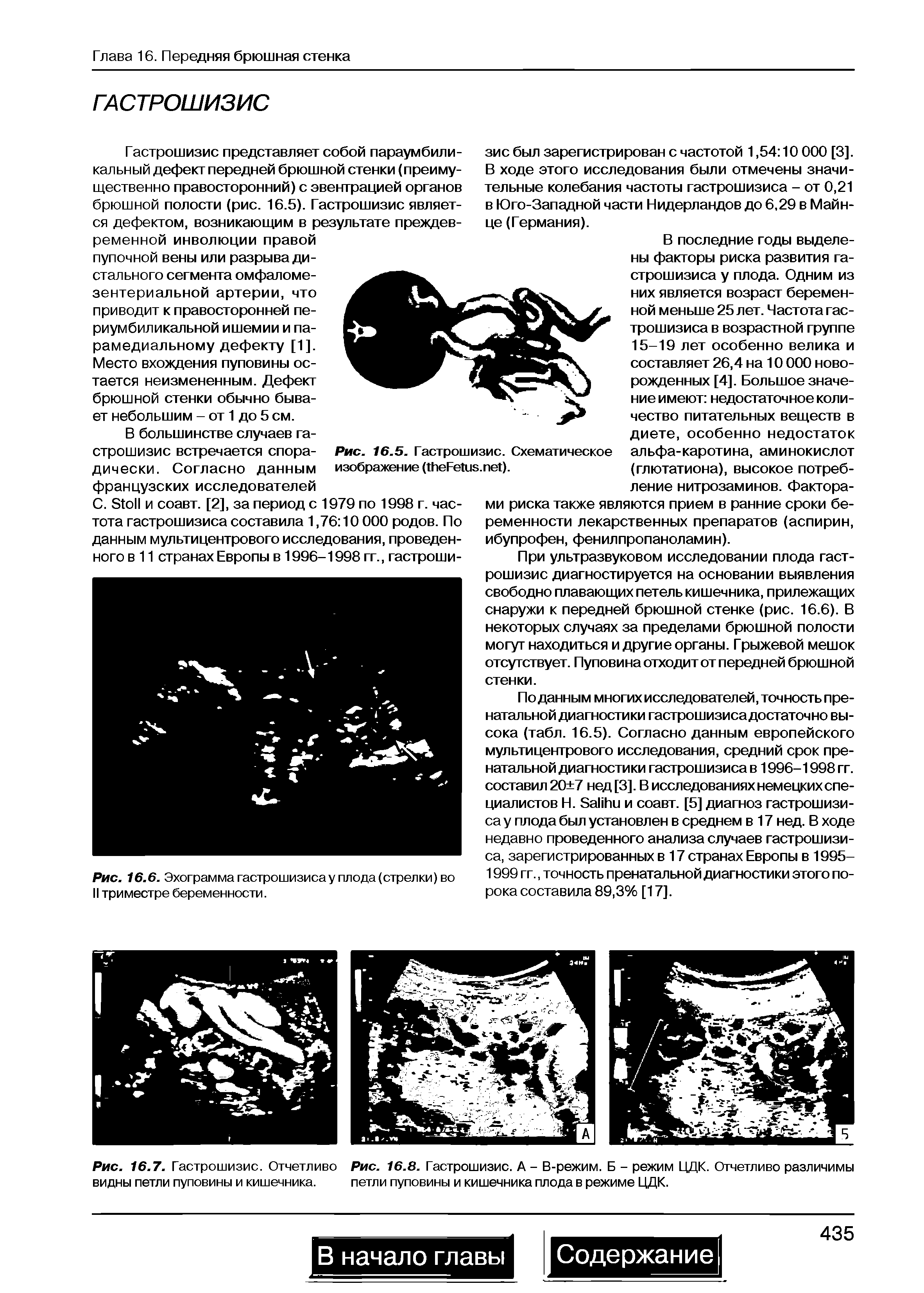 Рис. 16.8. Гастрошизис. А - В-режим. Б - режим ЦДК. Отчетливо различимы петли пуповины и кишечника плода в режиме ЦДК.