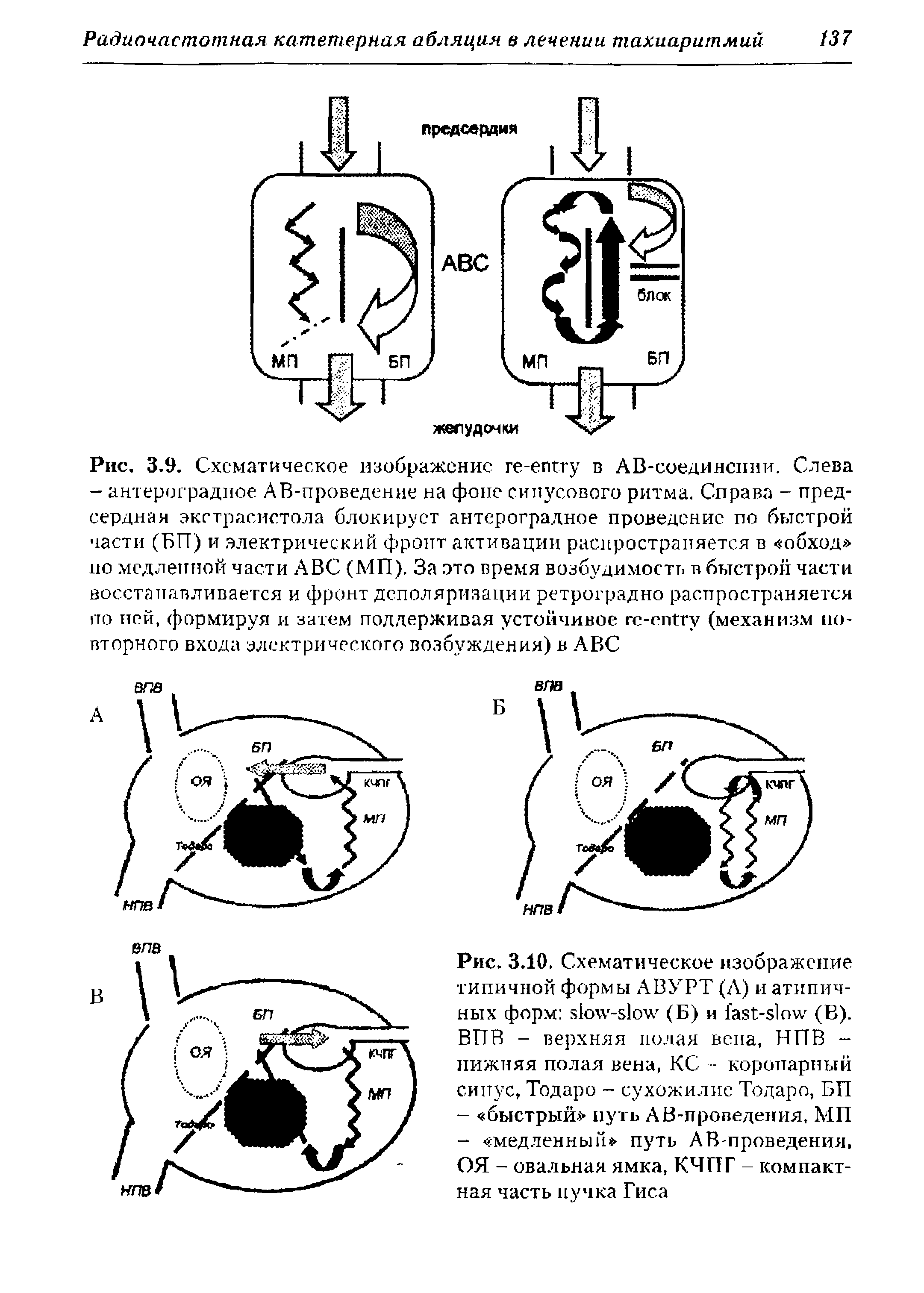 Рис. 3.10. Схематическое изображение типичной формы АВУРТ (Л) и атипичных форм - (Б) и - (В). ВПВ - верхняя полая вена, НПВ -нижняя полая вена, КС - коронарный синус, Тодаро - сухожилие Тодаро, БП...