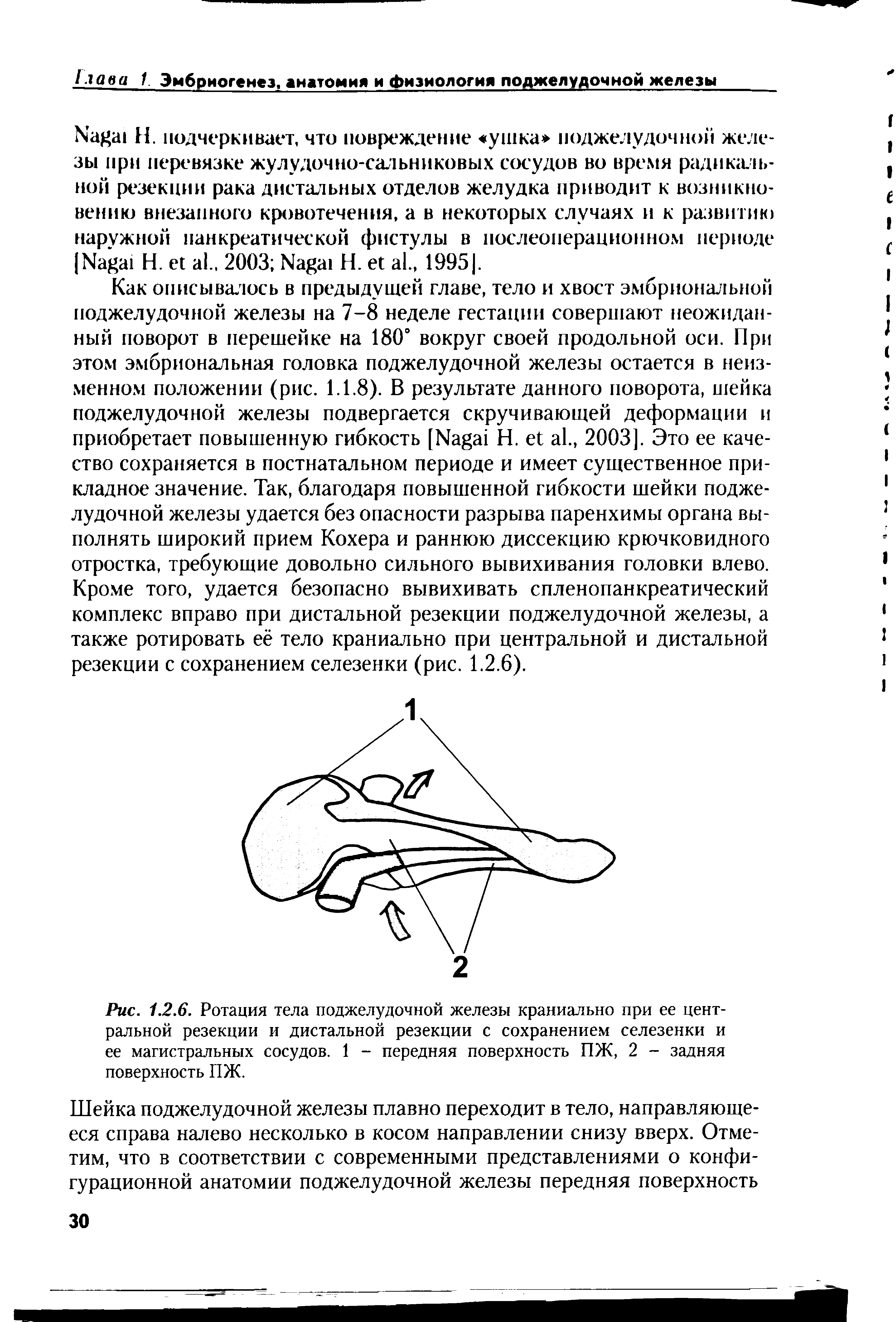 Рис. 1.2.6. Ротация тела поджелудочной железы краниально при ее центральной резекции и дистальной резекции с сохранением селезенки и ее магистральных сосудов. 1 - передняя поверхность ПЖ, 2 - задняя поверхность ПЖ.