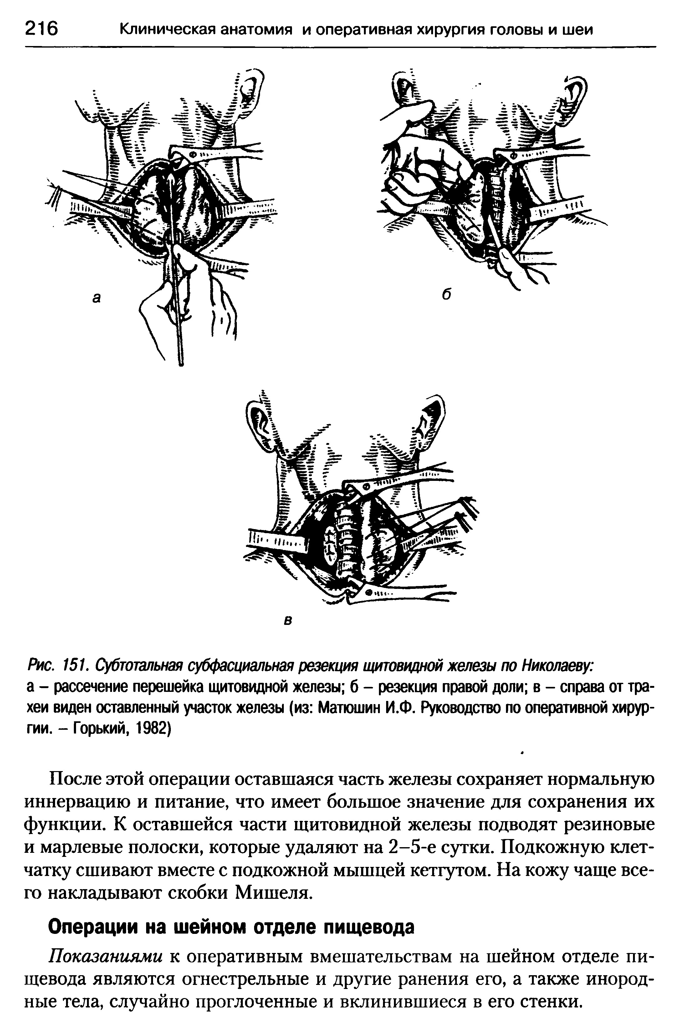 Рис. 151. Субтотальная субфасциальная резекция щитовидной железы по Николаеву а - рассечение перешейка щитовидной железы б - резекция правой доли в - справа от трахеи виден оставленный участок железы (из Матюшин И.Ф. Руководство по оперативной хирургии. - Горький, 1982)...
