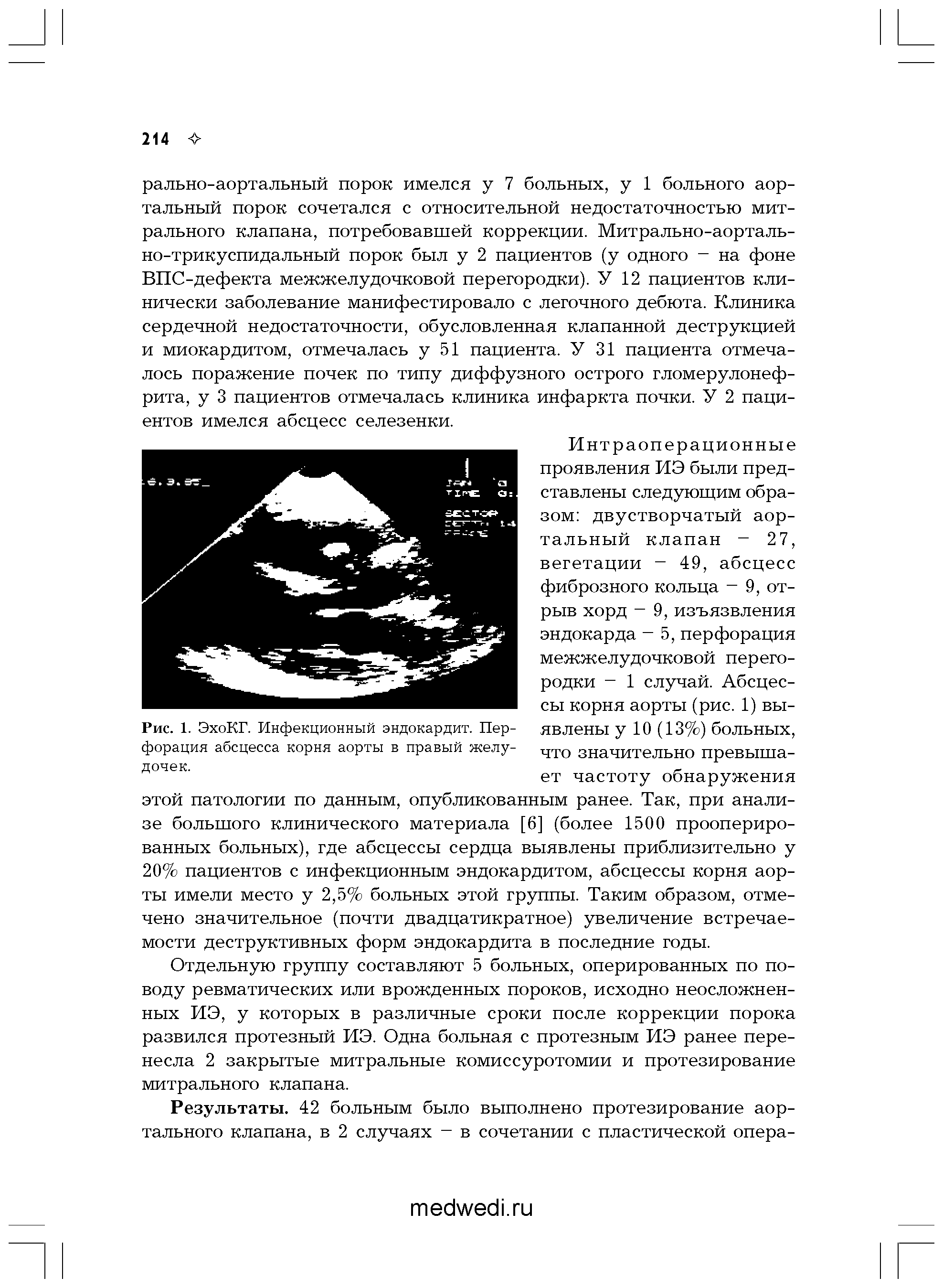 Рис. 1. ЭхоКГ. Инфекционный эндокардит. Перфорация абсцесса корня аорты в правый желудочек.