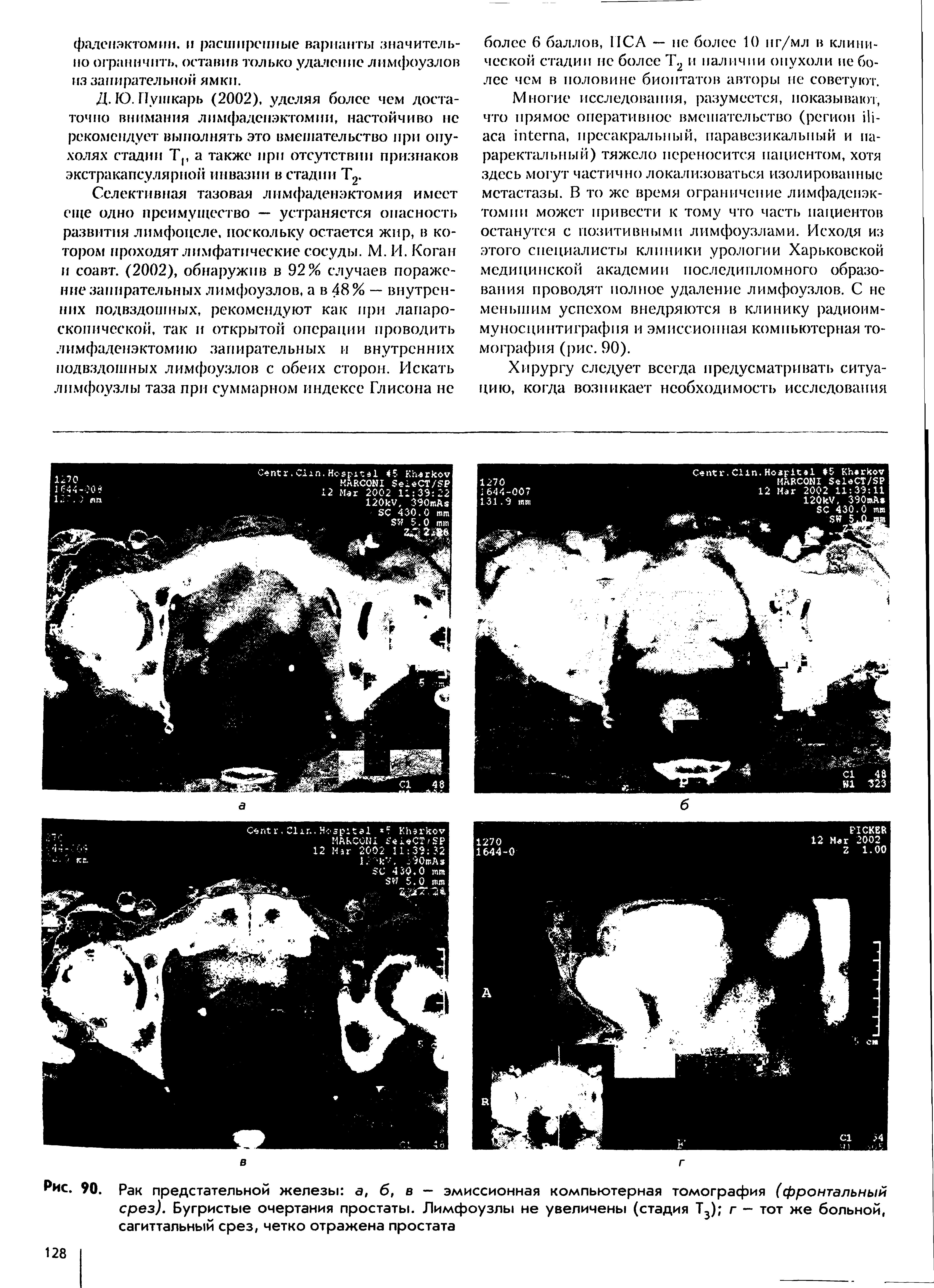 Рис. 90. Рак предстательной железы а, б, в — эмиссионная компьютерная томография (фронтальный срез). Бугристые очертания простаты. Лимфоузлы не увеличены (стадия Т3) г — тот же больной, сагиттальный срез, четко отражена простата...