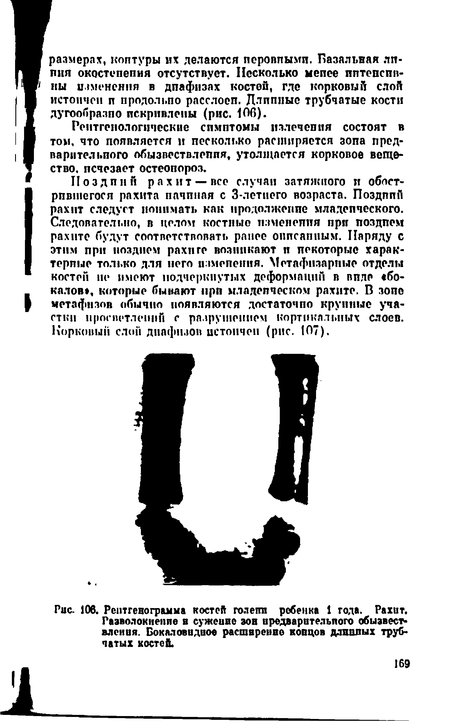 Рис. 106. Рентгенограмма костей голепп ребенка 1 года. Рахит. Разволокнение в сужеиие зов предварительного обызвествления. Бокал овидиое расширение копцов дошлых трубчатых костей.