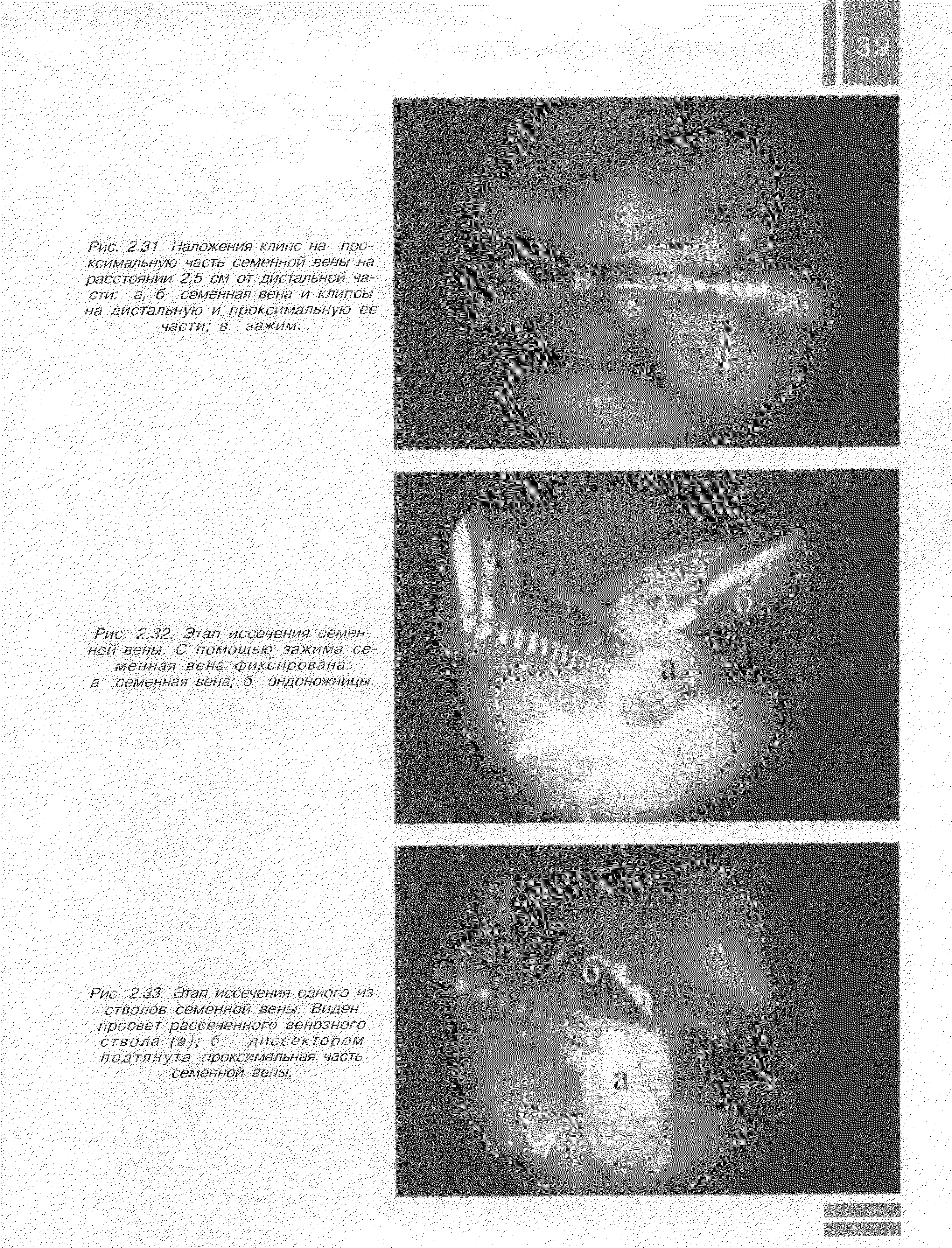 Рис. 2.32. Этап иссечения семенной вены. С помощью зажима се- ...
