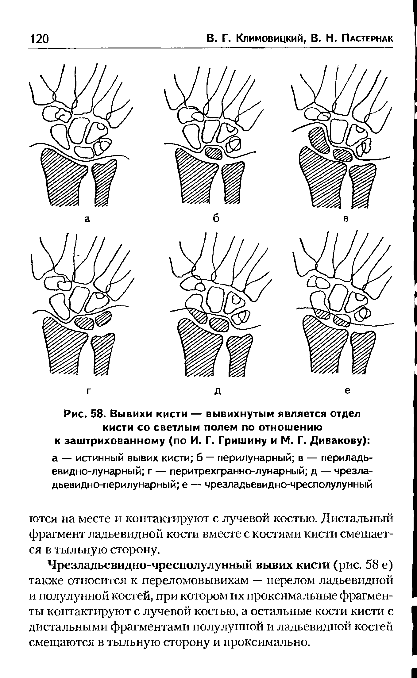 Рис. 58. Вывихи кисти — вывихнутым является отдел кисти со светлым полем по отношению к заштрихованному (по И. Г. Гришину и М. Г. Дивакову) а — истинный вывих кисти б — перилунарный в — периладь-евидно-лунарный г — перитрехгранно-лунарный д — чрезла-дьевидно-перилунарный е — чрезладьевидно-чресполулунный...