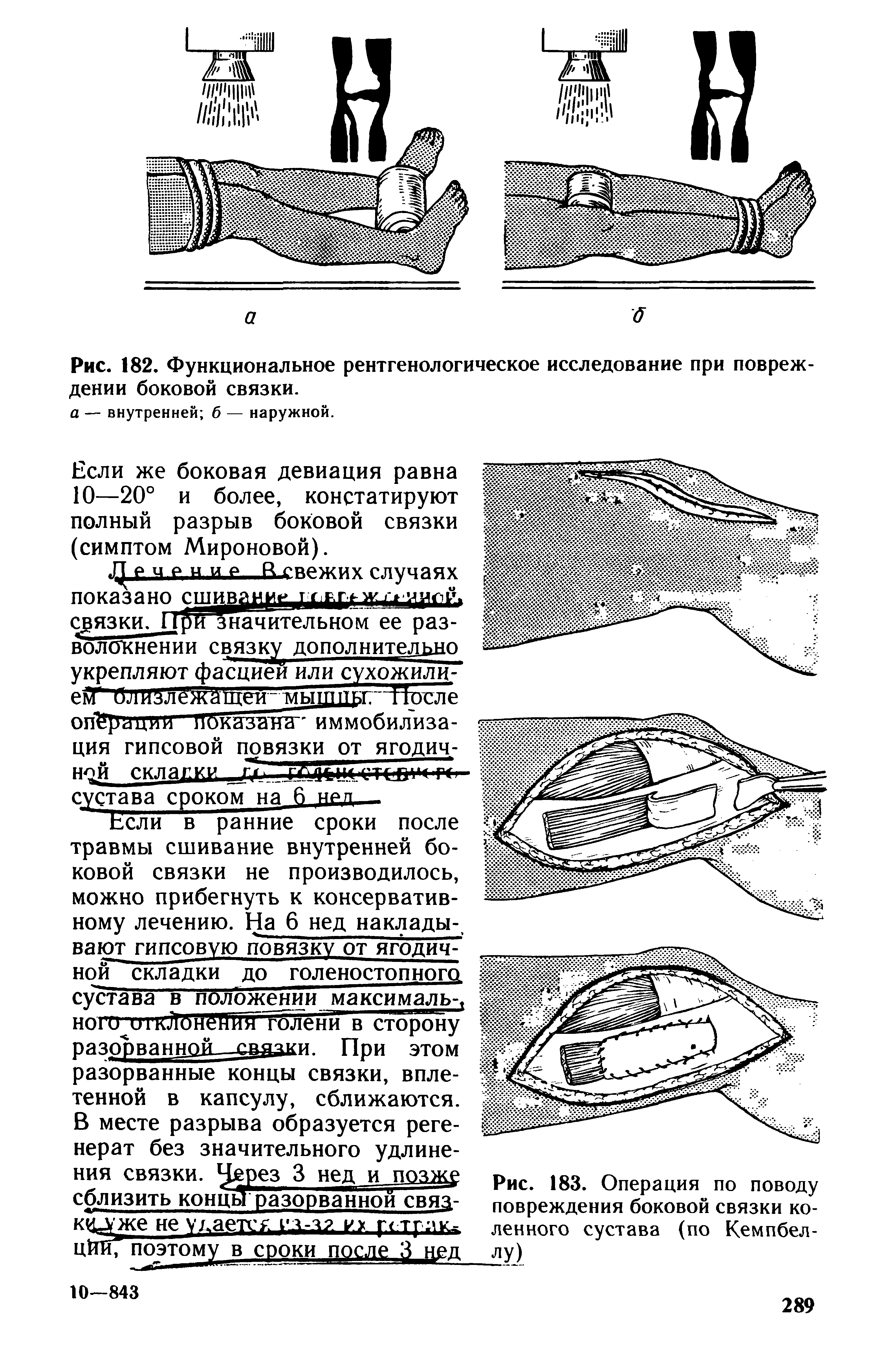 Рис. 183. Операция по поводу повреждения боковой связки коленного сустава (по Кемпбеллу)...