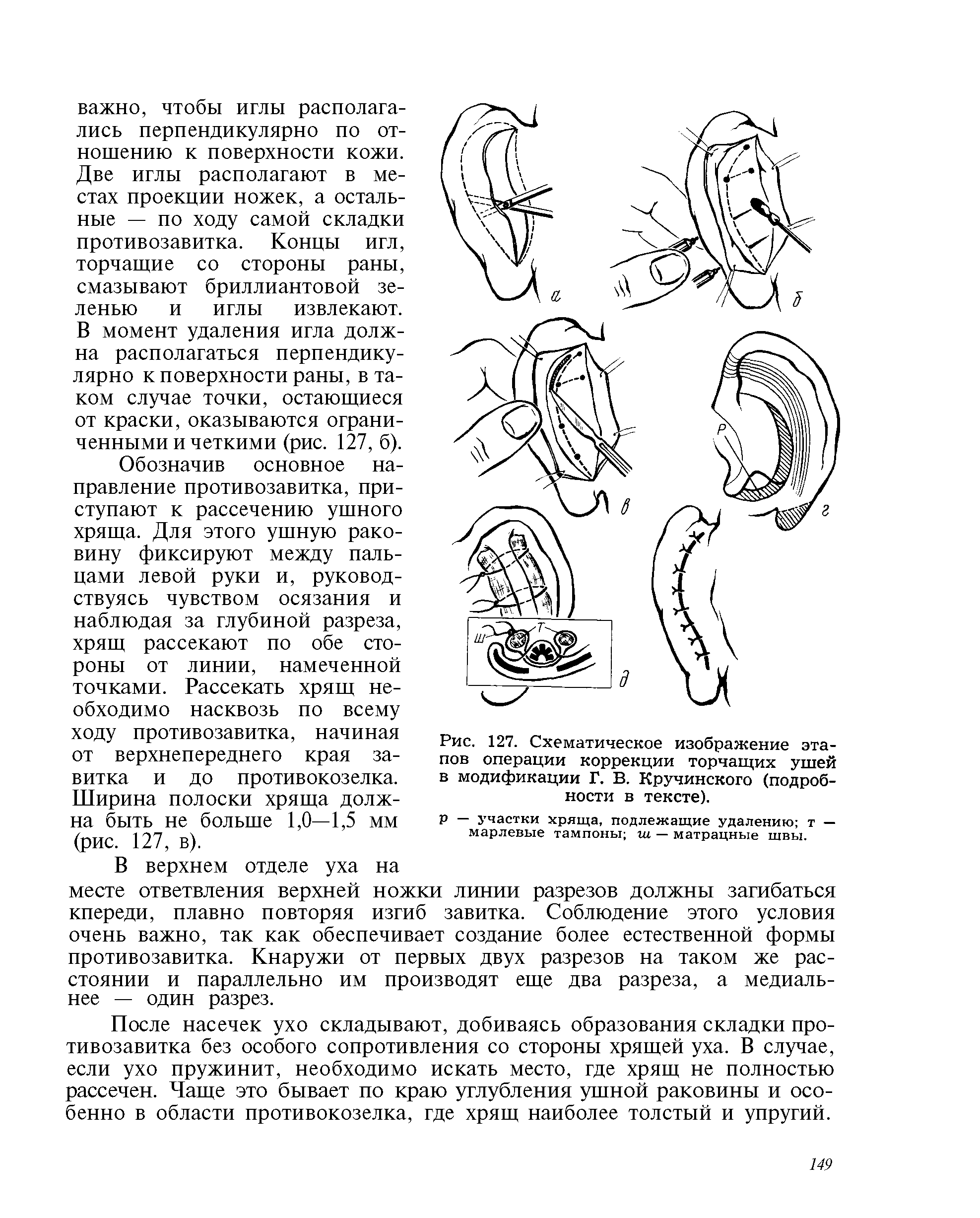 Рис. 127. Схематическое изображение этапов операции коррекции торчащих ушей в модификации Г. В. Кручинского (подробности в тексте).