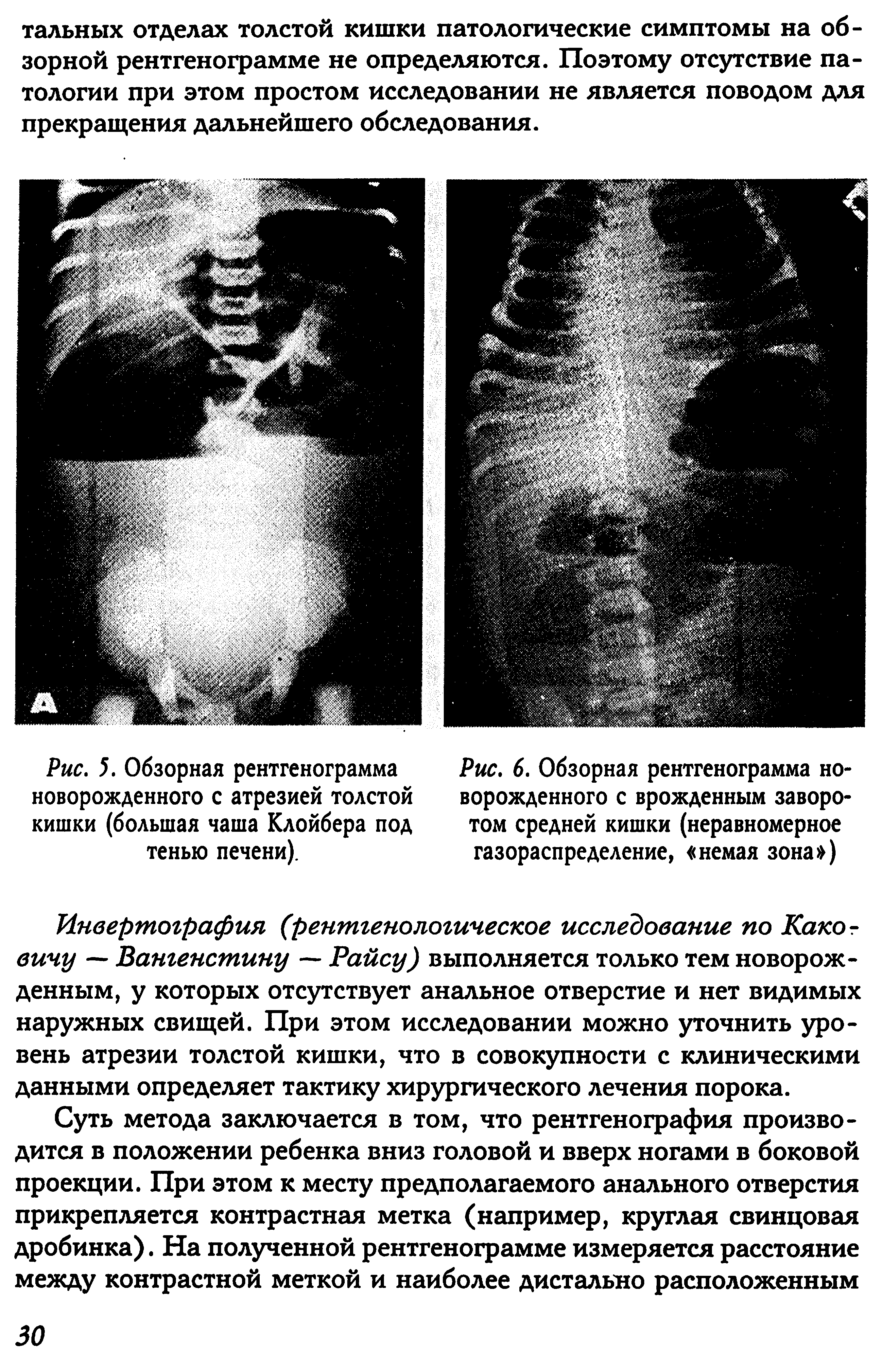 Рис. 6. Обзорная рентгенограмма новорожденного с врожденным заворотом средней кишки (неравномерное газораспределение, немая зона )...