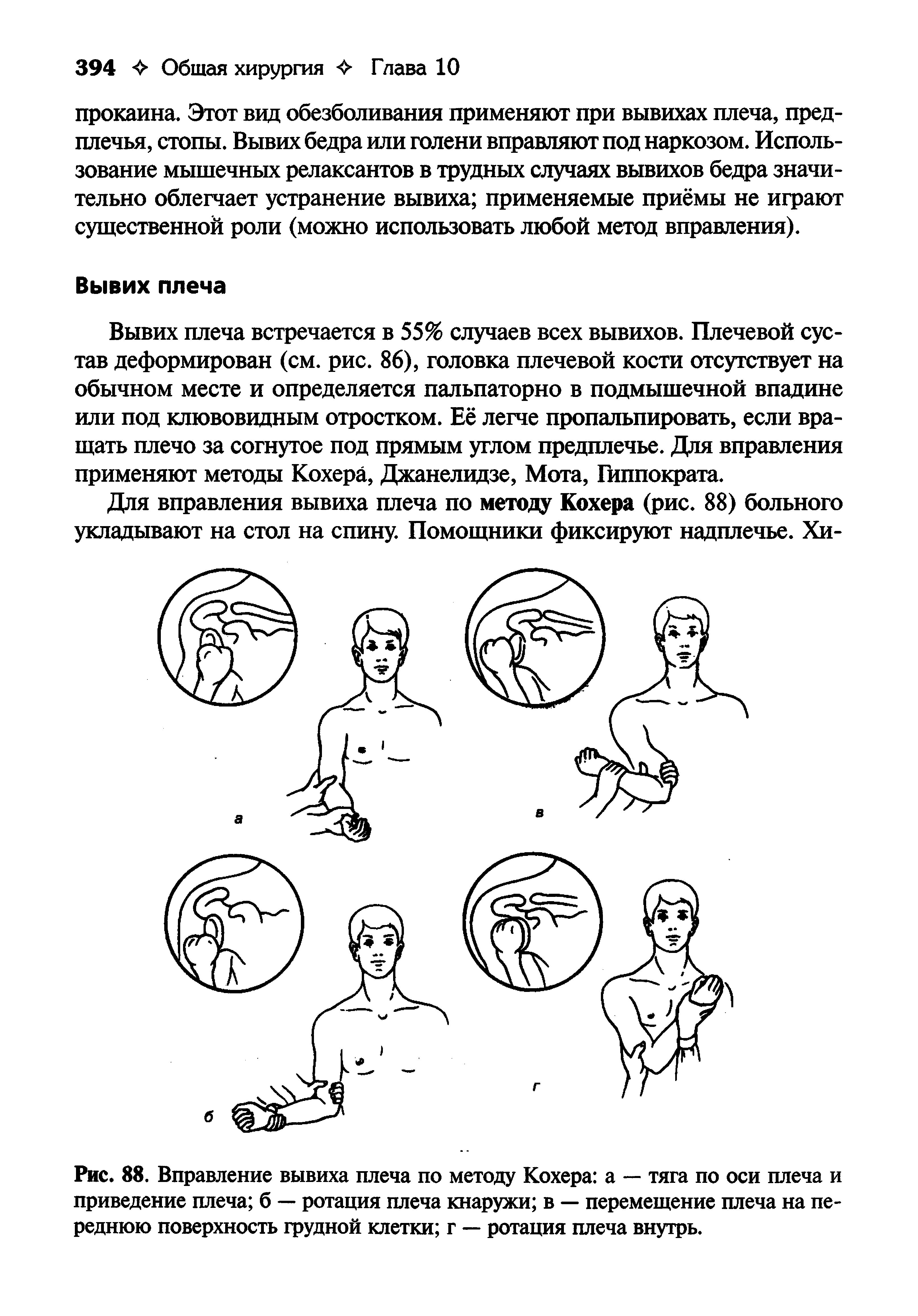 Рис. 88. Вправление вывиха плеча по методу Кохера а — тяга по оси плеча и приведение плеча б — ротация плеча кнаружи в — перемещение плеча на переднюю поверхность грудной клетки г — ротация плеча внутрь.