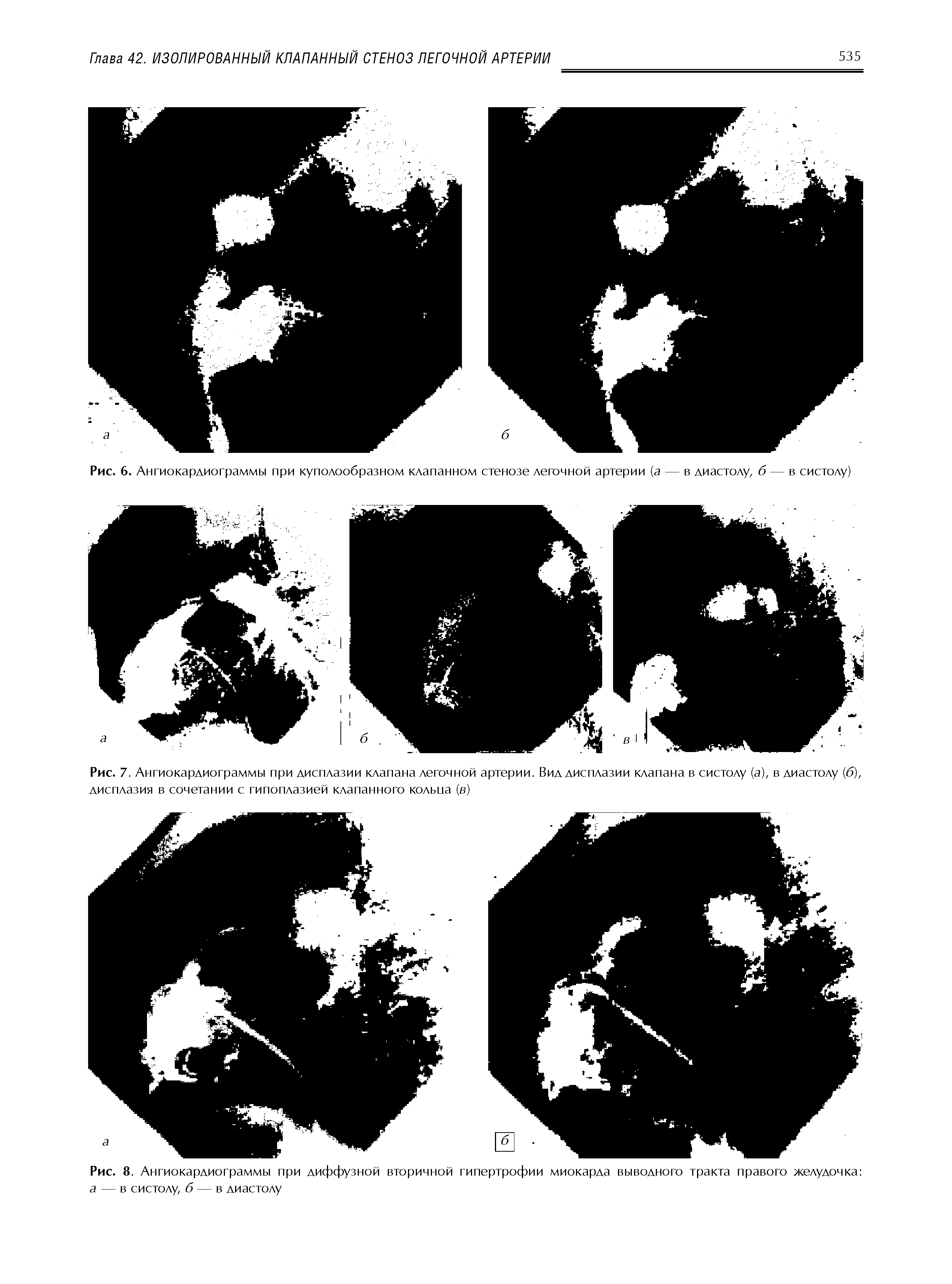 Рис. 7. Ангиокардиограммы при дисплазии клапана легочной артерии. Вид дисплазии клапана в систолу (а), в диастолу (б), дисплазия в сочетании с гипоплазией клапанного кольна (в)...