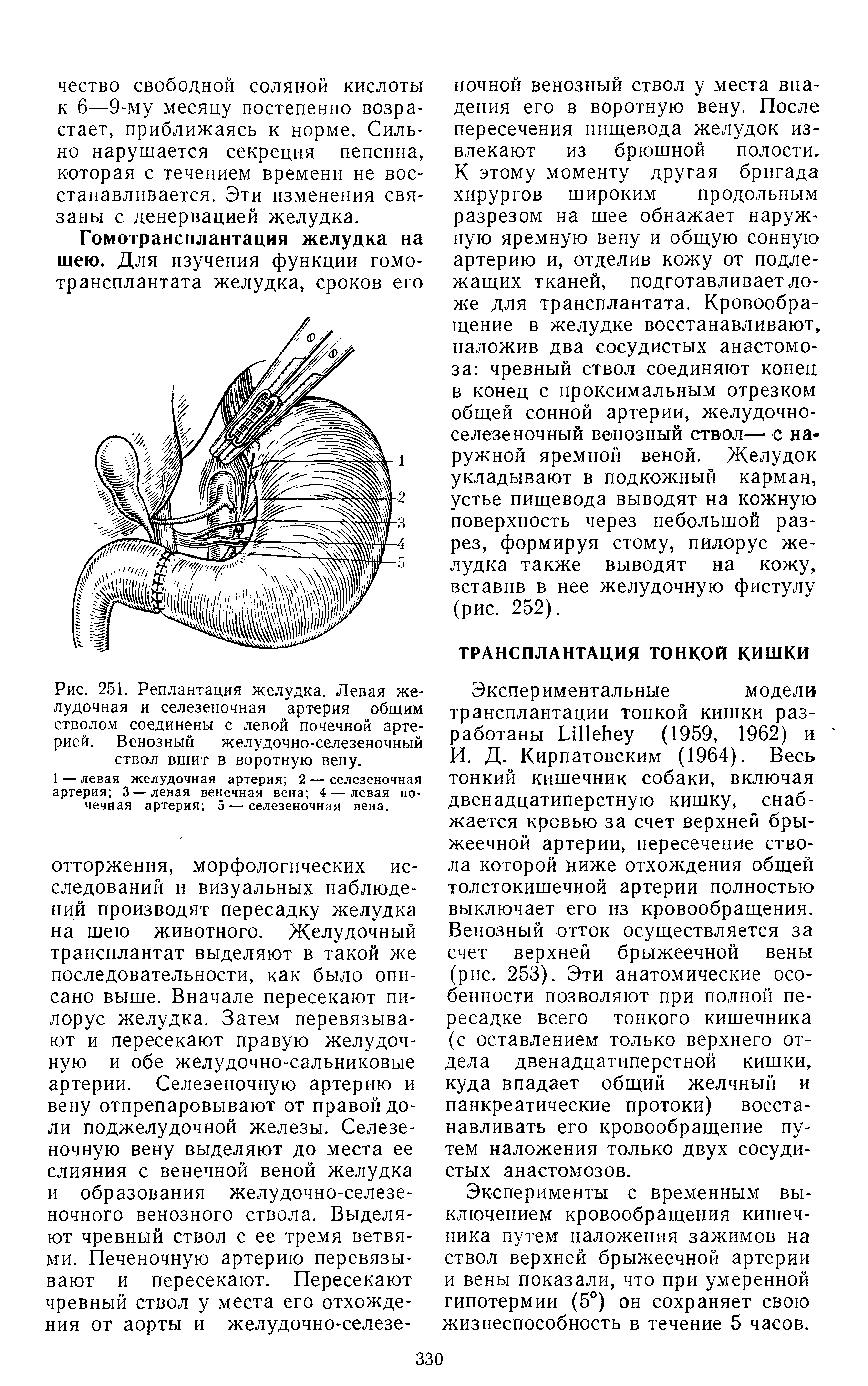 Рис. 251. Реплантация желудка. Левая желудочная и селезеночная артерия общим стволом соединены с левой почечной артерией. Венозный желудочно-селезеночный ствол вшит в воротную вену.