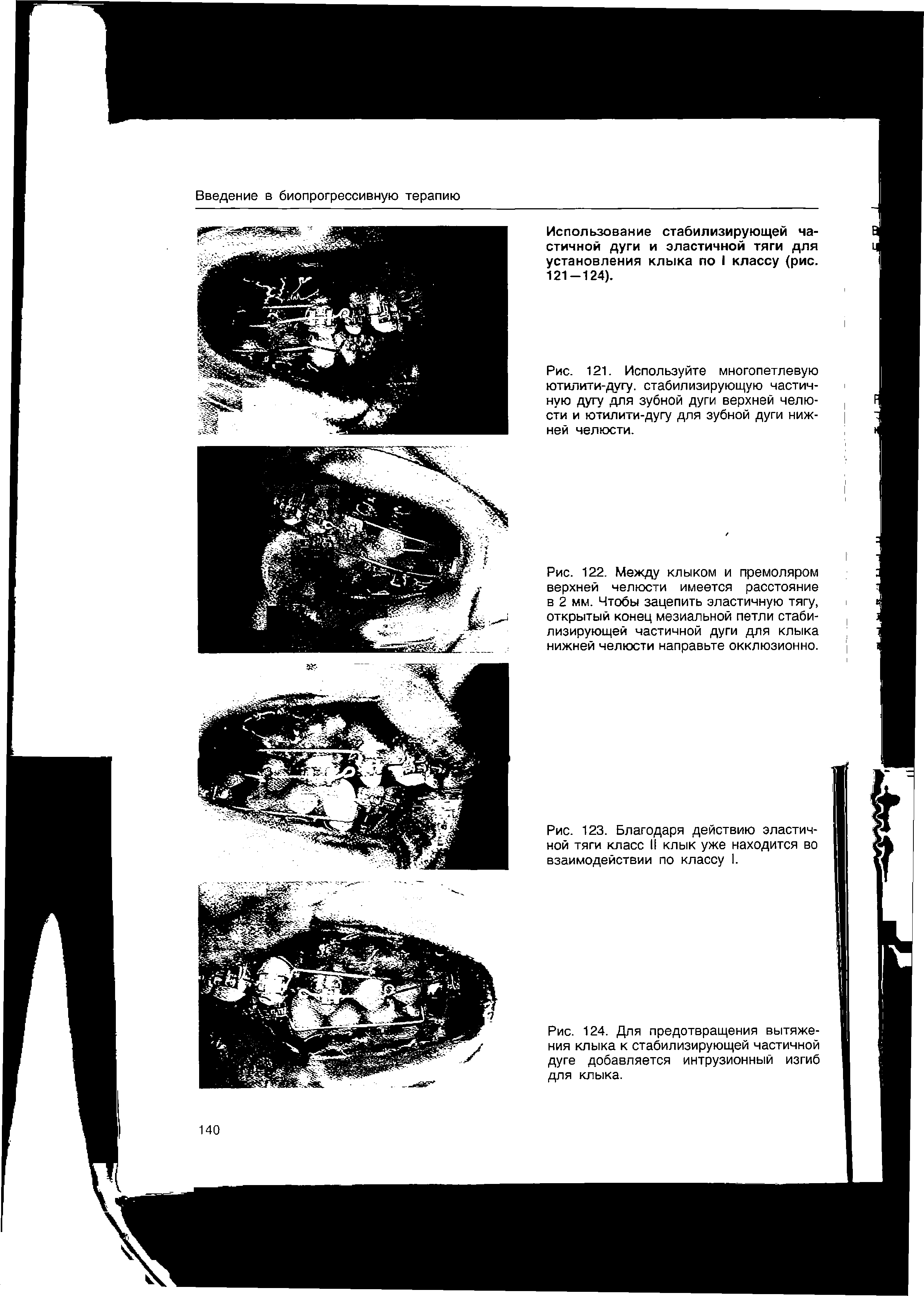 Рис. 122. Между клыком и премоляром верхней челюсти имеется расстояние в 2 мм. Чтобы зацепить эластичную тягу, открытый конец мезиальной петли стабилизирующей частичной дуги для клыка нижней челюсти направьте окклюзионно.