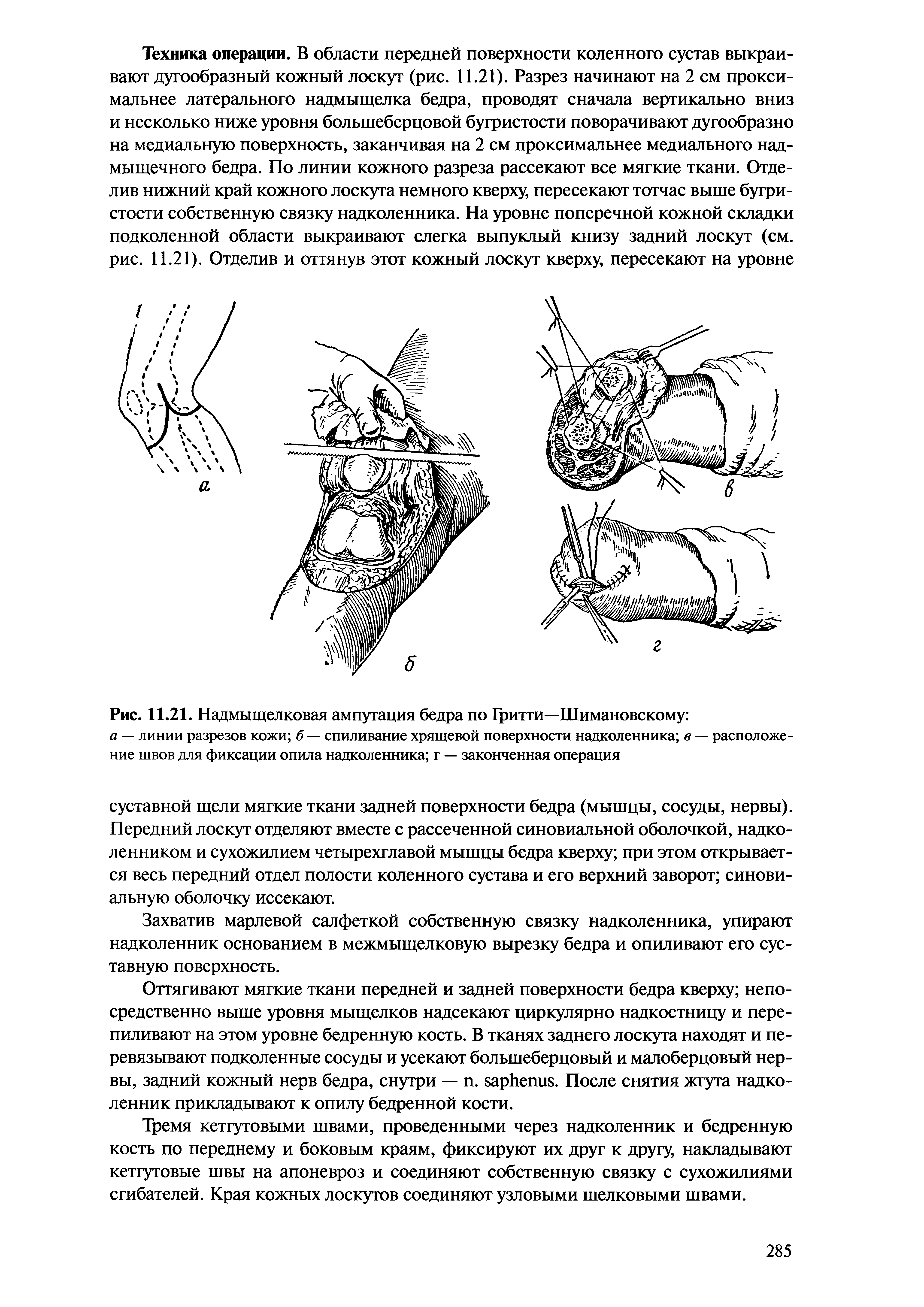 Рис. 11.21. Надмыщелковая ампутация бедра по Гритти—Шимановскому а — линии разрезов кожи б — спиливание хрящевой поверхности надколенника в — расположение швов для фиксации опила надколенника г — законченная операция...