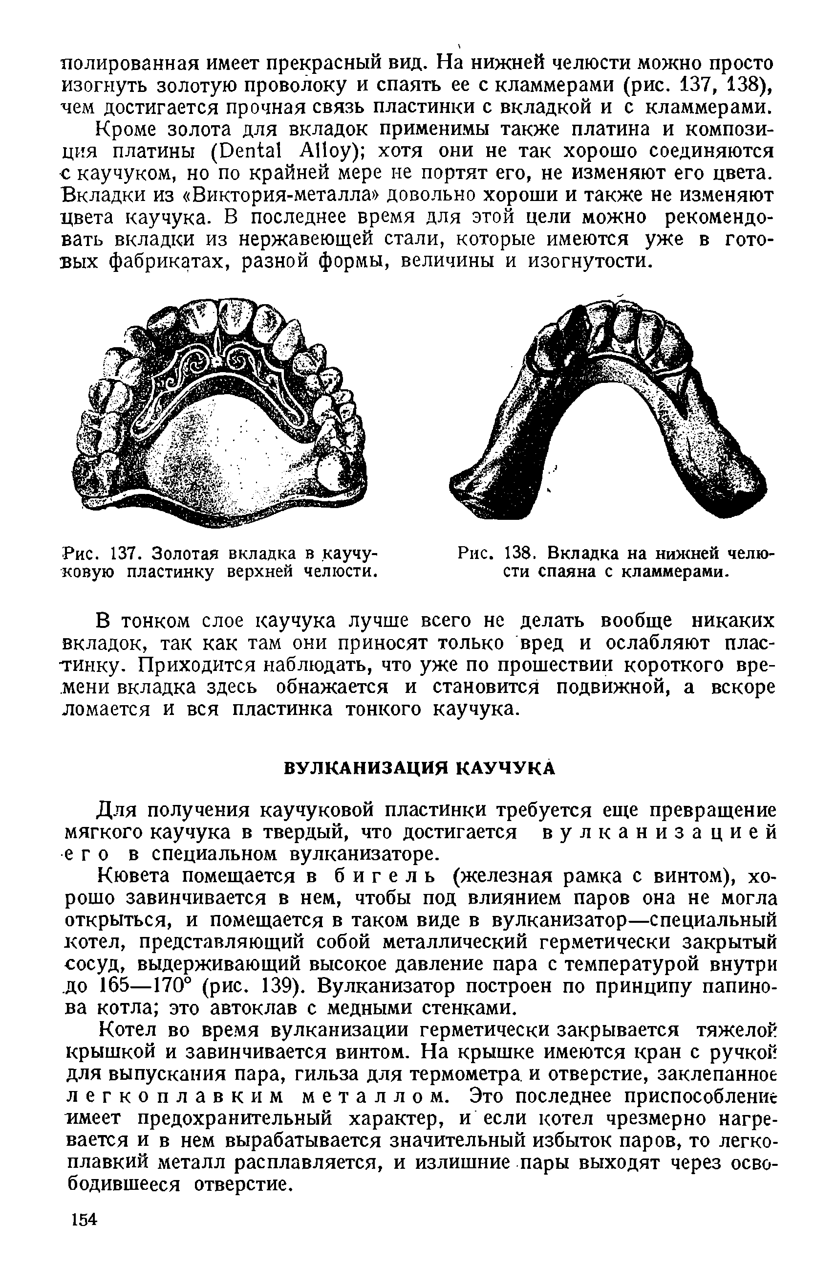 Рис. 137. Золотая вкладка в каучуковую пластинку верхней челюсти.