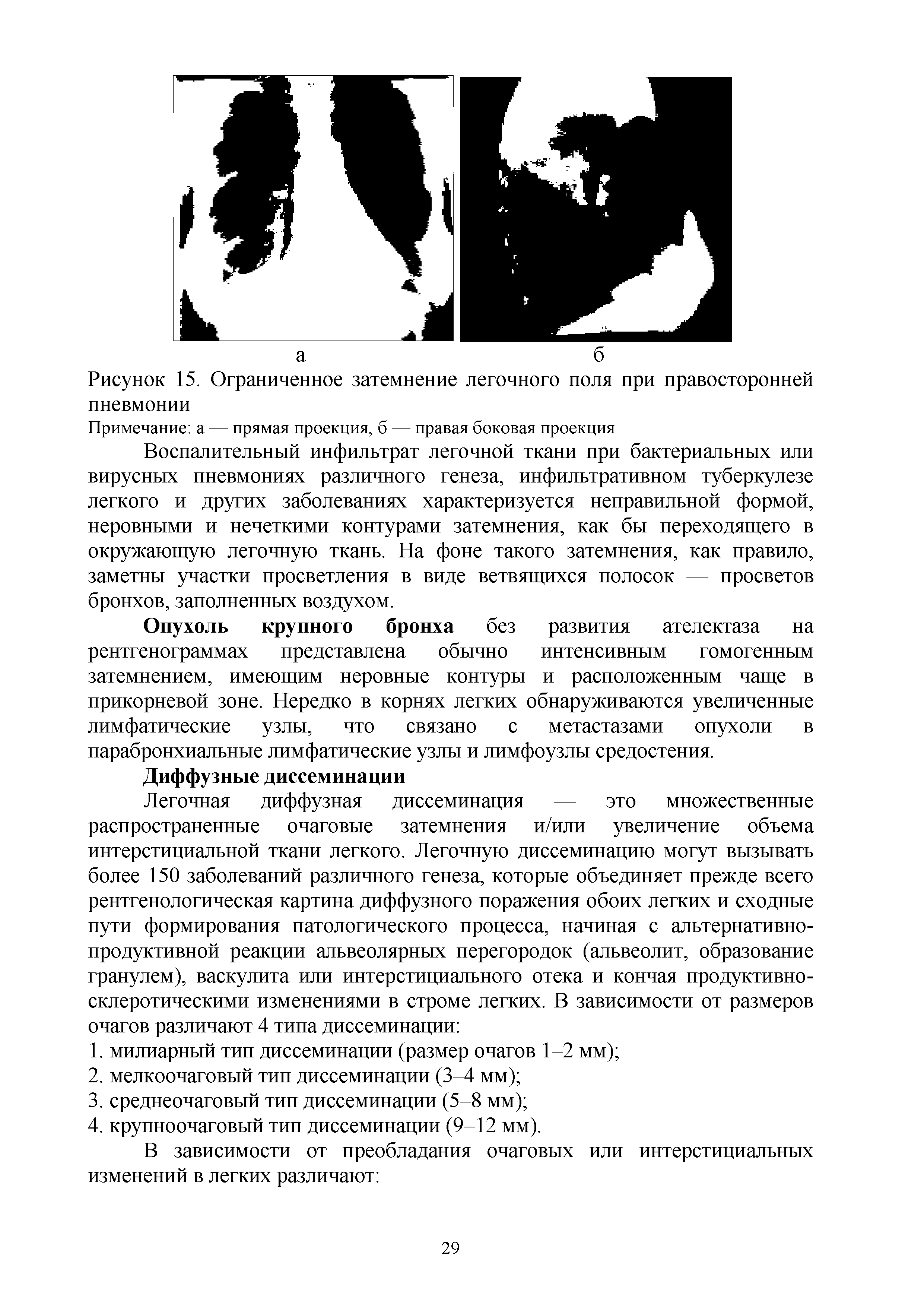 Рисунок 15. Ограниченное затемнение легочного поля при правосторонней пневмонии...