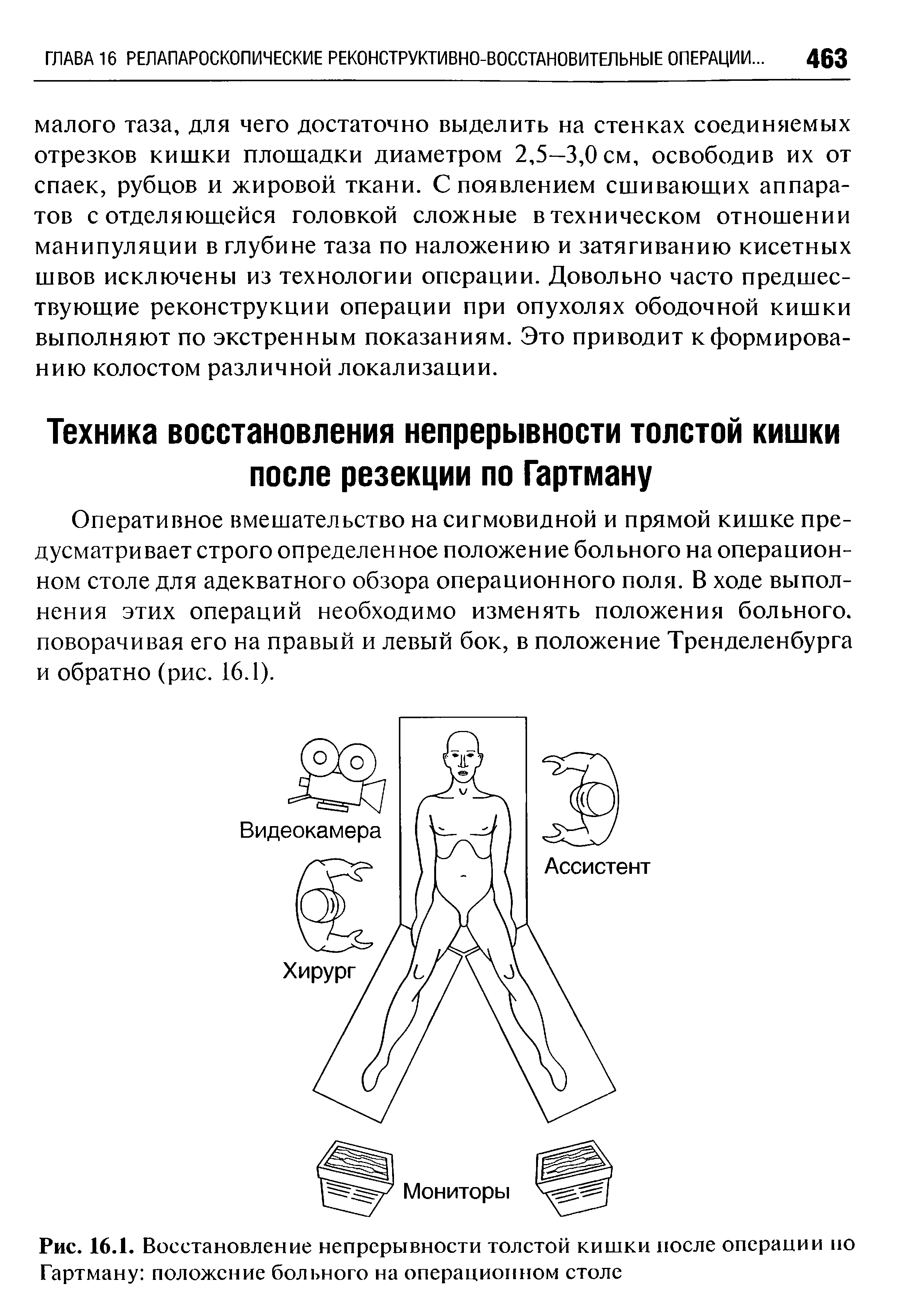 Рис. 16.1. Восстановление непрерывности толстой кишки после операции но Гартману положение больного на операционном столе...