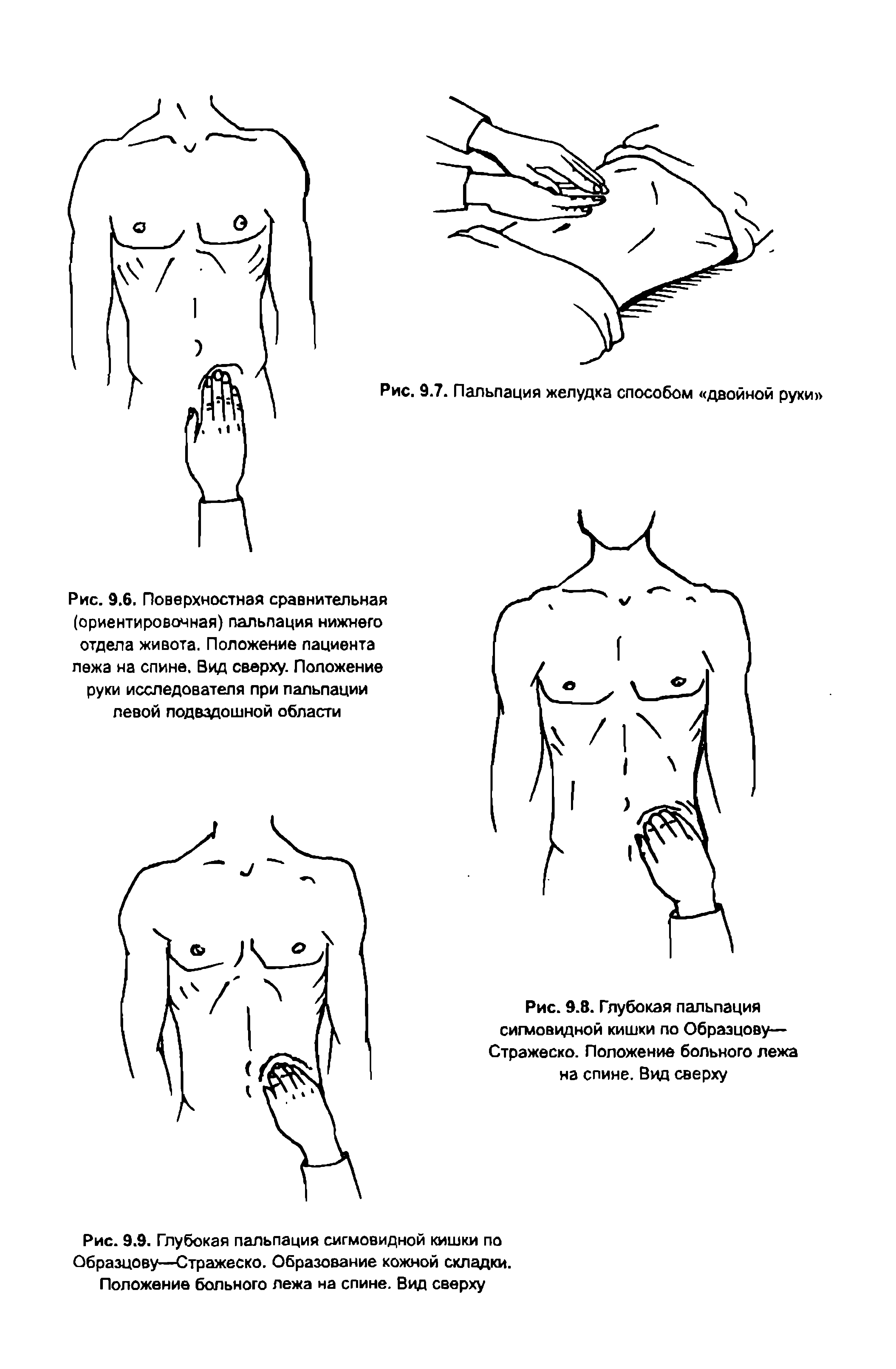 Рис. 9.8. Глубокая пальпация сигмовидной кишки по Образцову— Стражеско. Положение больного лежа на спине. Вид сверху...