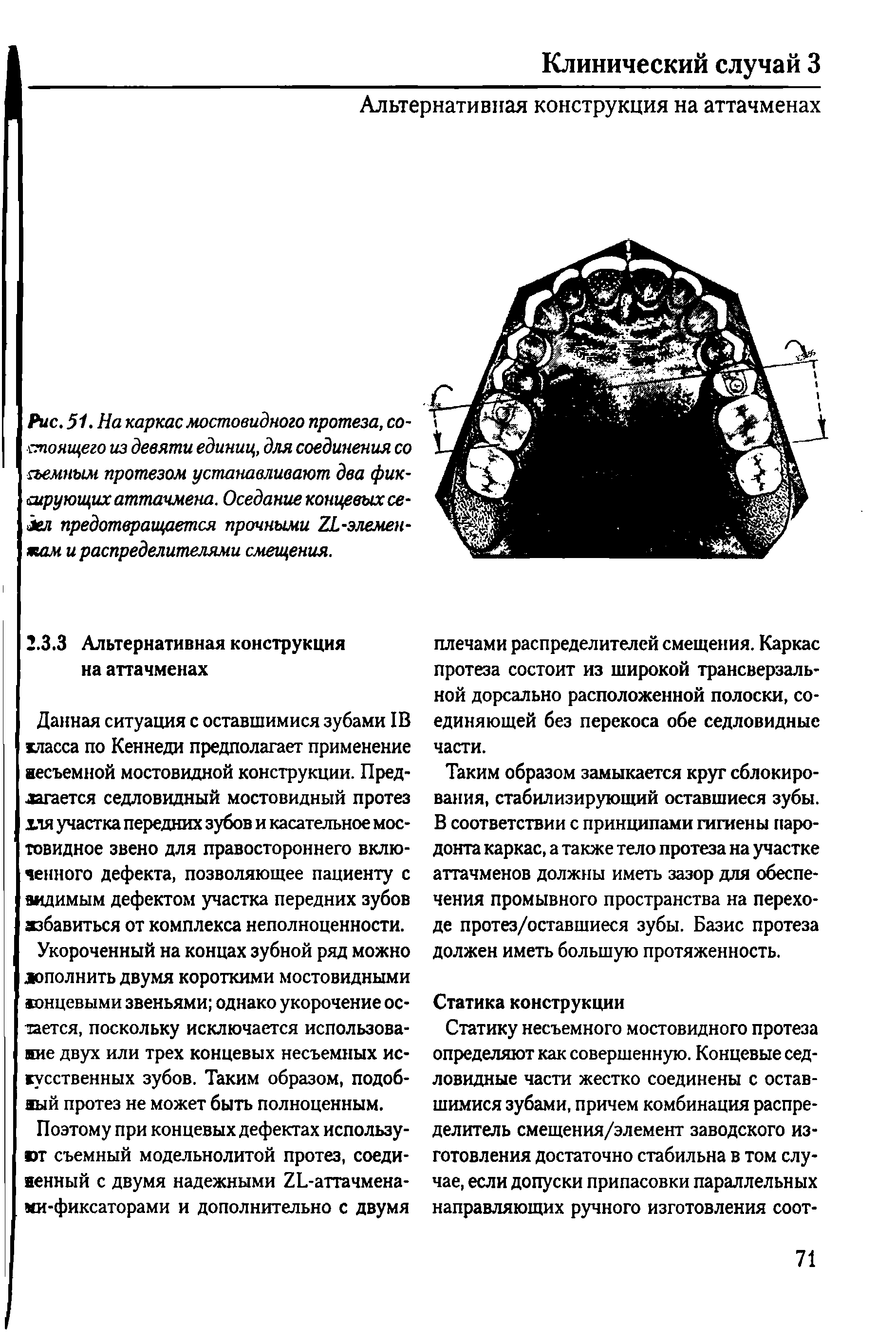 Рис. 51. На каркас мостовидного протеза, состоящего из девяти единиц, для соединения со съемным протезом устанавливают два фиксирующих аттачмена. Оседание концевых седел предотвращается прочными 2к-элемен-яшм и распределителями смещения.