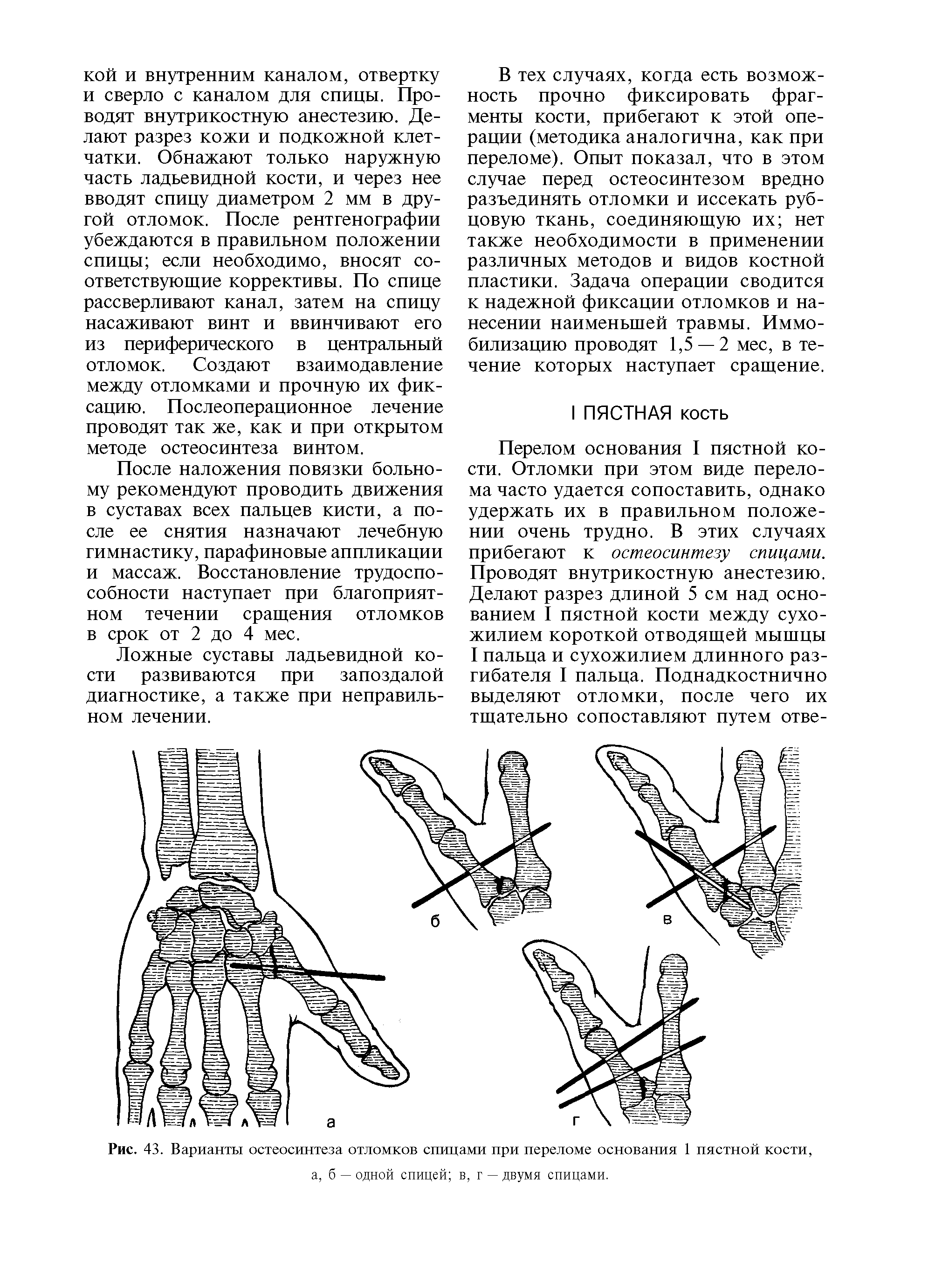 Рис. 43. Варианты остеосинтеза отломков спицами при переломе основания 1 пястной кости,...