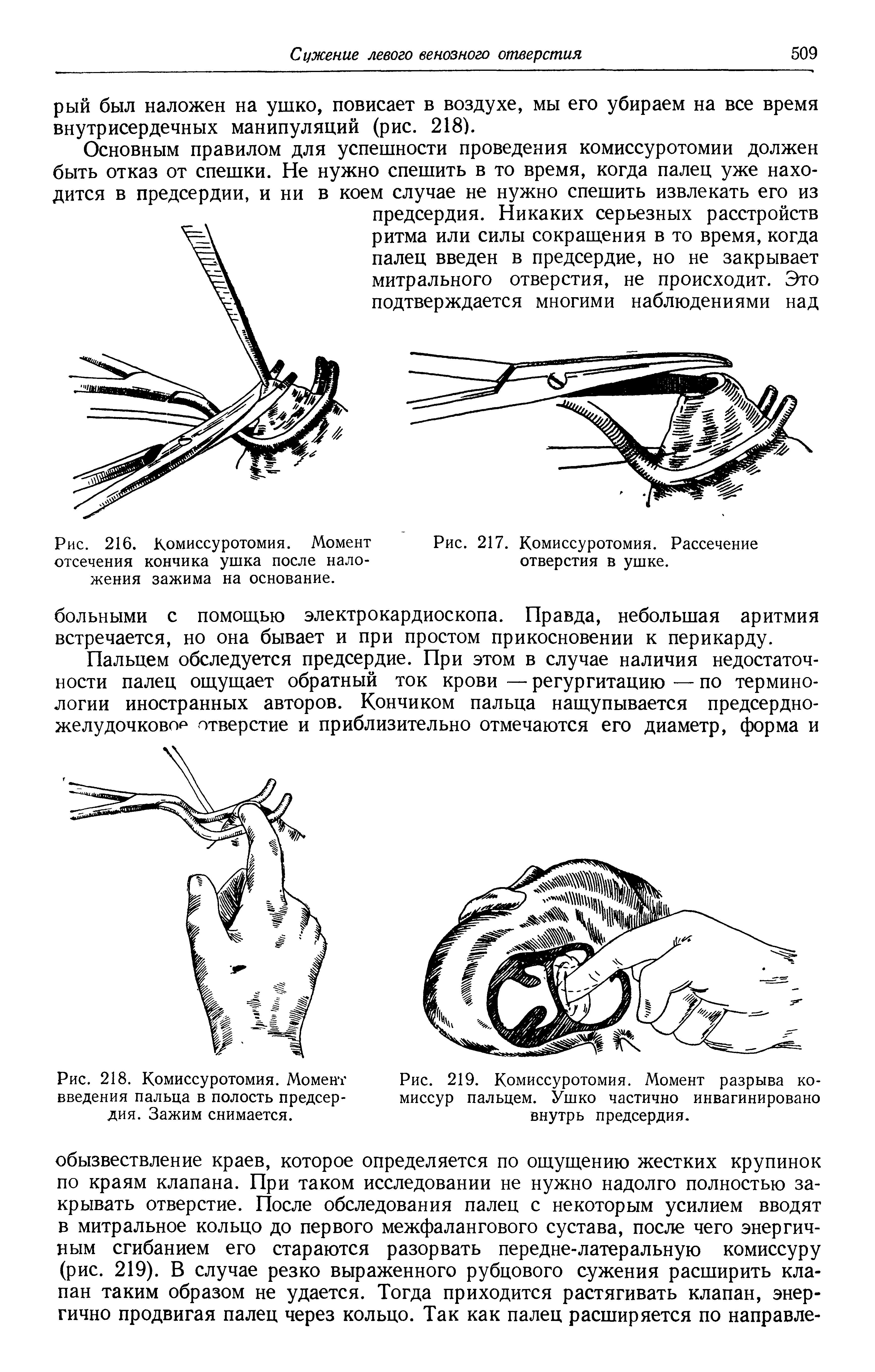 Рис. 219. Комиссуротомия. Момент разрыва комиссур пальцем. Ушко частично инвагинировано внутрь предсердия.