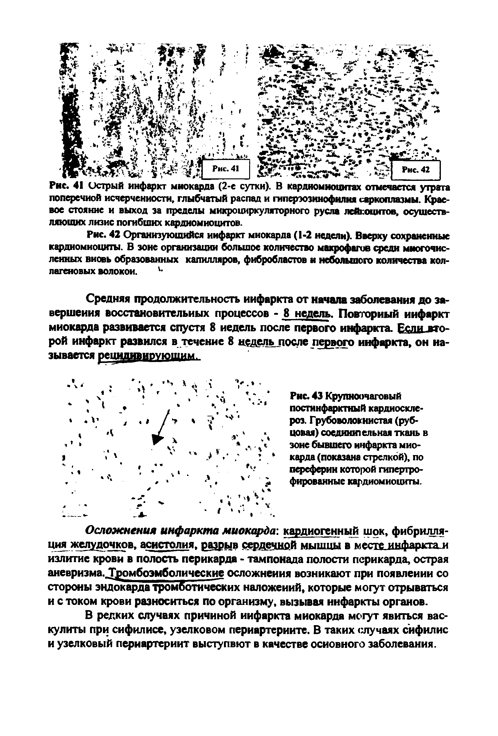 Рис. 43 Крупноочаговый постинфарктный кардиосклероз. Грубоволокнистая (рубцовая) соединительная ткань в зоне бывшего инфаркта миокарда (показана стрелкой), по переферин которой гипертрофированные кардиомиониты.