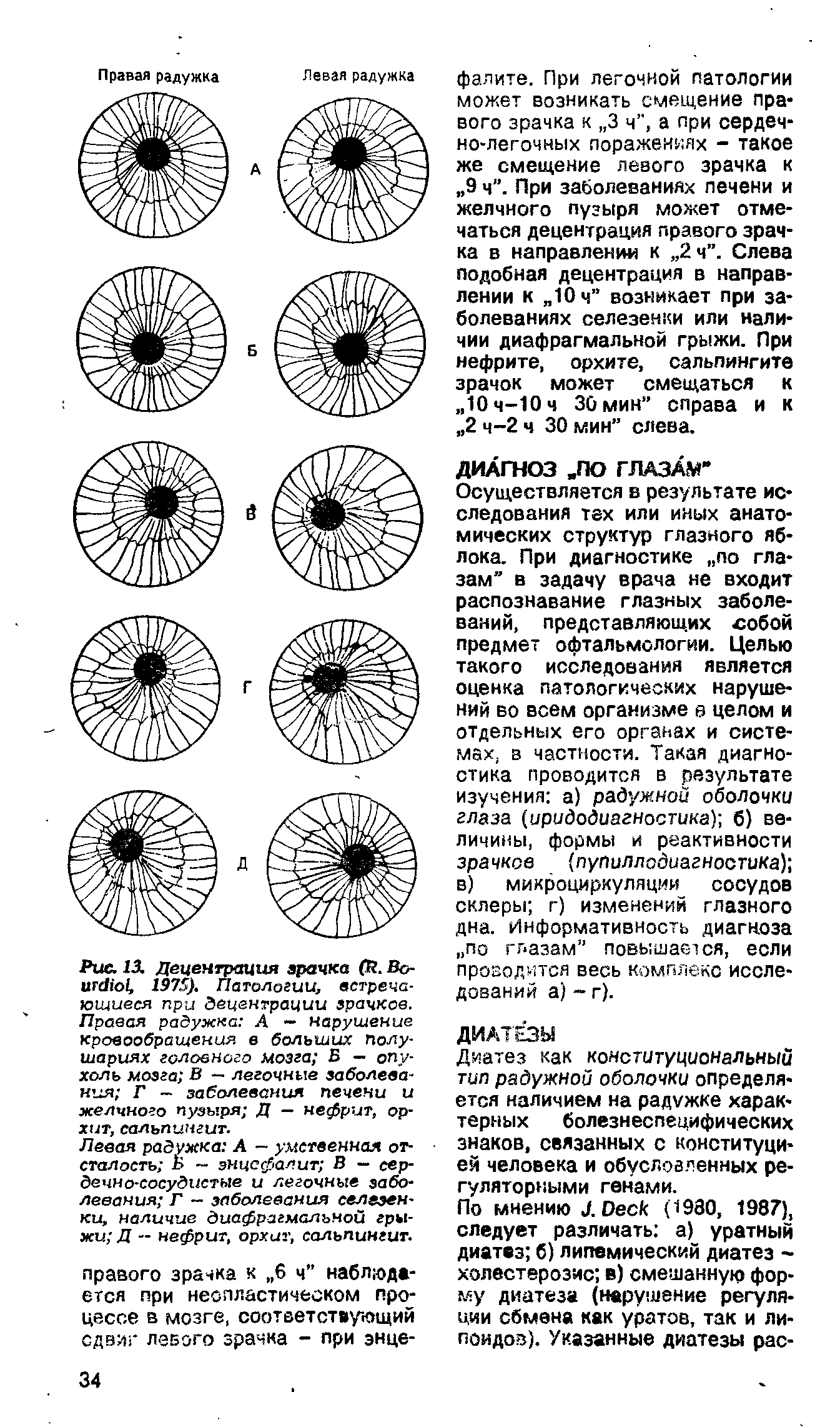 Рис. 13. Децентрация зрачка (R. Во- , 1975). Патологии, встречающиеся при Эецентрации зрачков. Правая радужка А - нарушение кровообращения в больших полушариях головного мозга Б — опухоль мозга В — легочные заболевания Г - заболевания печени и желчного пузыря Д — нефрит, орхит, сальпингит.