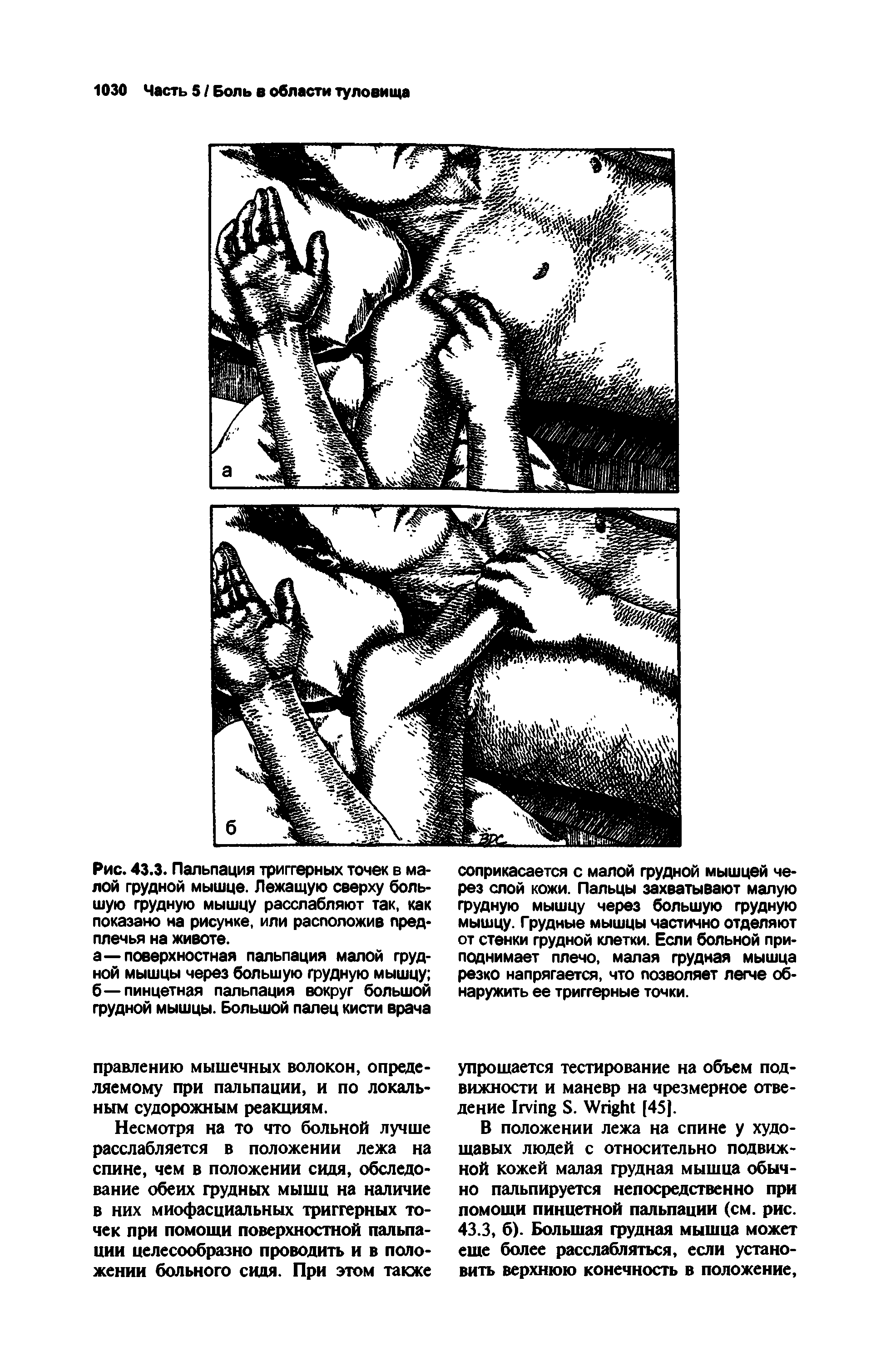 Рис. 43.3. Пальпация триггерных точек в малой грудной мышце. Лежащую сверху большую грудную мышцу расслабляют так, как показано на рисунке, или расположив предплечья на животе.