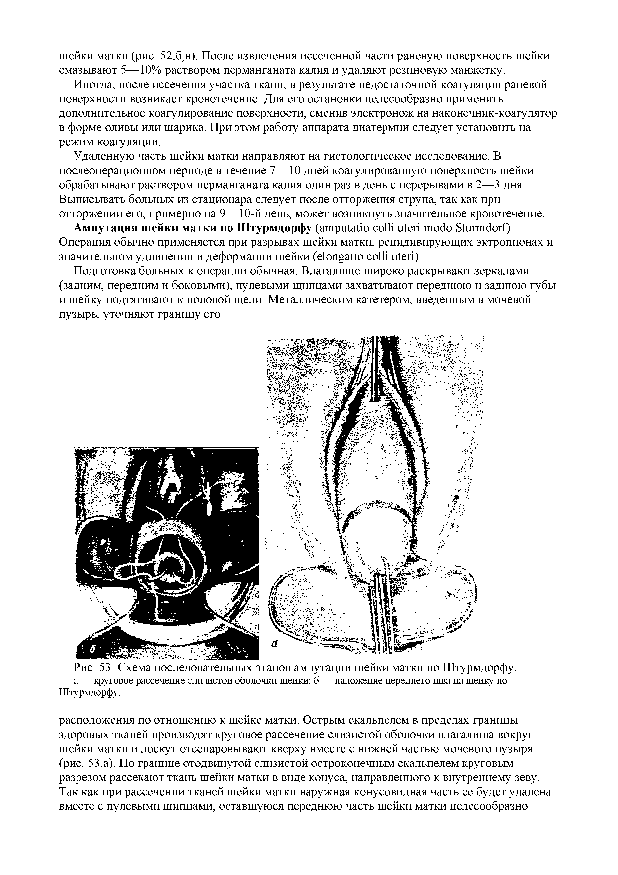 Рис. 53. Схема последовательных этапов ампутации шейки матки по Штурмдорфу. а — круговое рассечение слизистой оболочки шейки б — наложение переднего шва на шейку по Штурмдорфу.