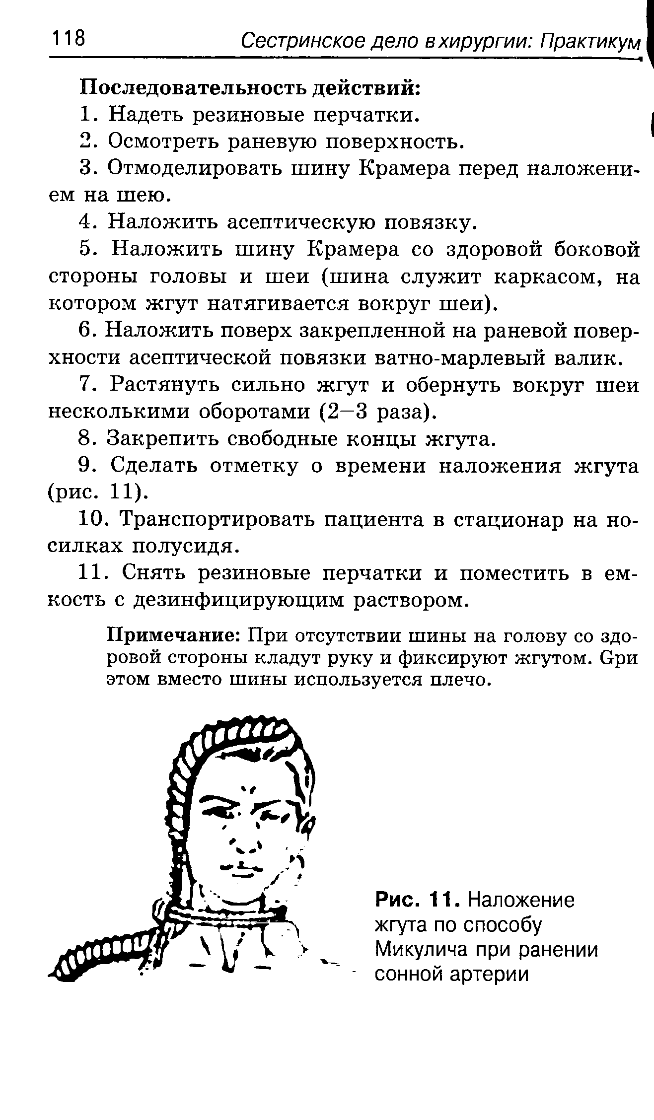 Рис. 11. Наложение жгута по способу Микулича при ранении сонной артерии...